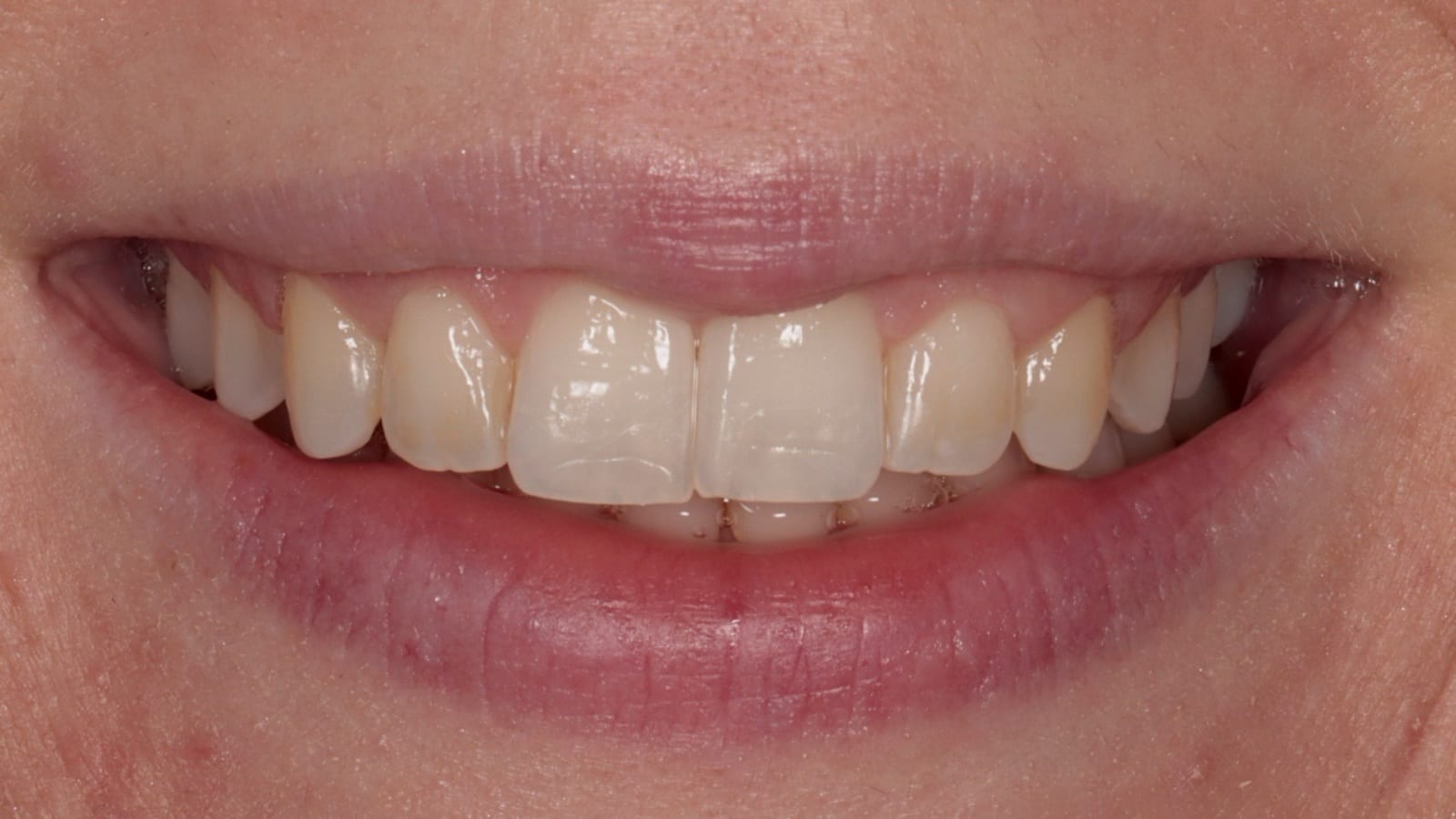 After — Anti-wrinkle injections — gummy smile correction