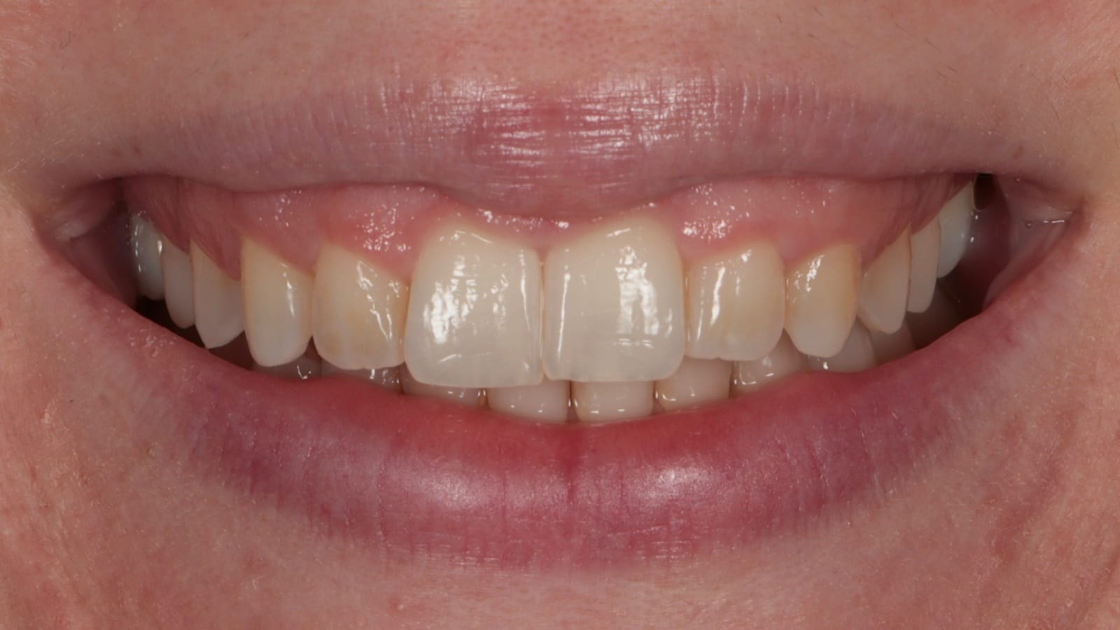 Before — Anti-wrinkle injections — gummy smile correction