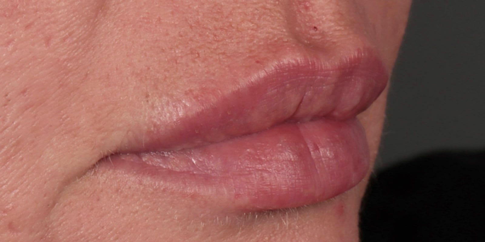 After — Dermal filler — natural lip enhancement