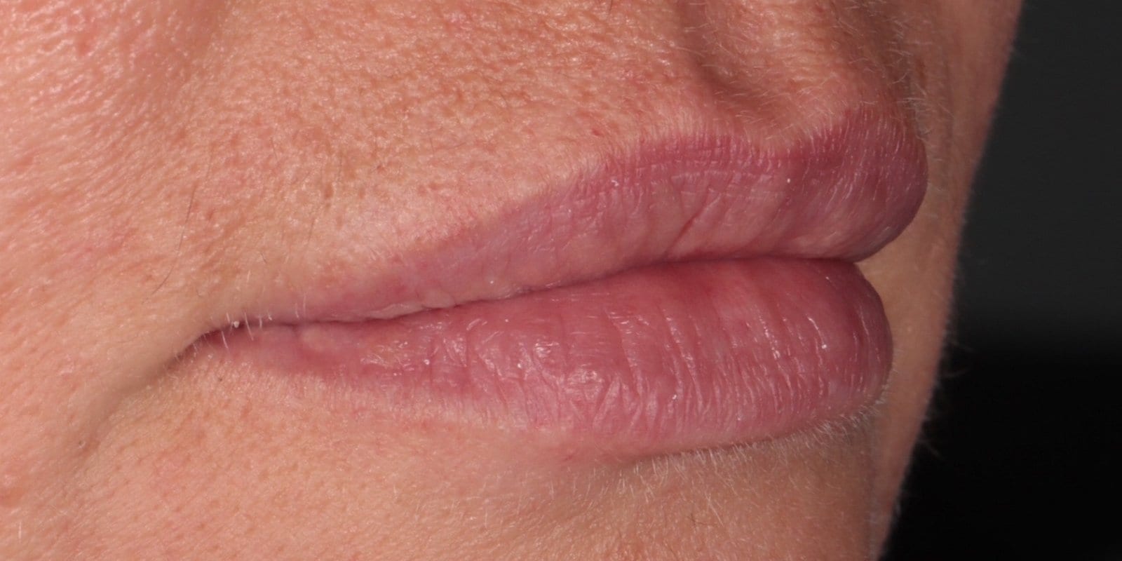 Before — Dermal filler — natural lip enhancement