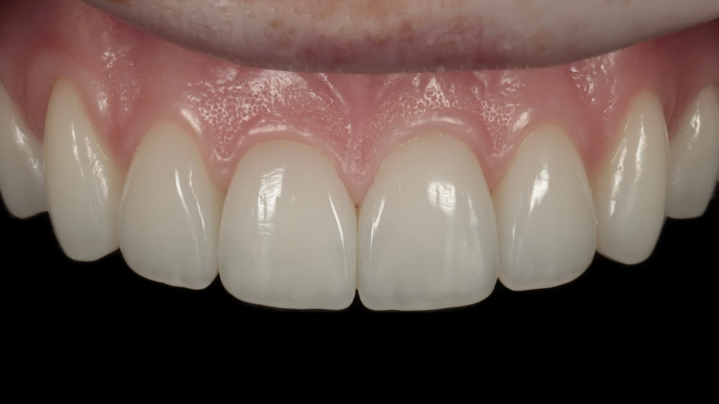 A natural smile finished with hand-sculpted composite bonding by Dr. Albert Gajdos