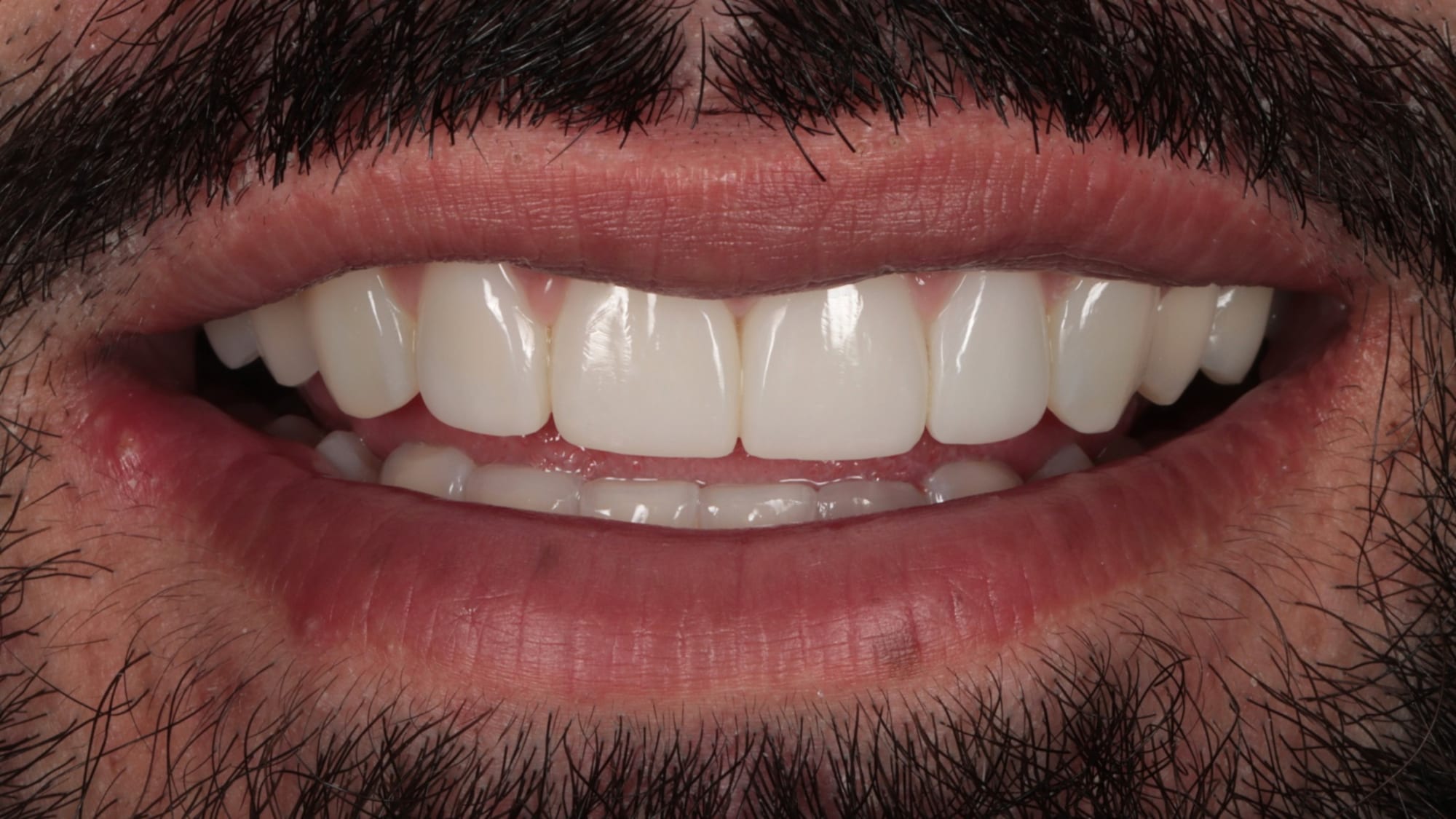 After — Invisalign + Hollywood composite bonding