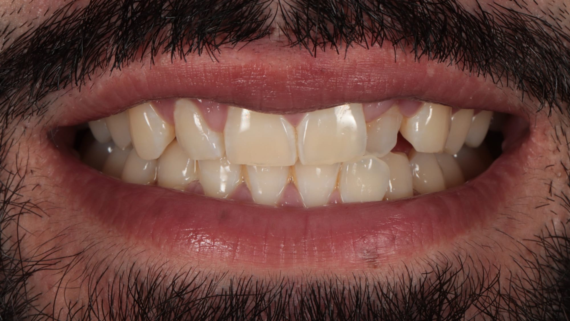 Before — Invisalign + Hollywood composite bonding
