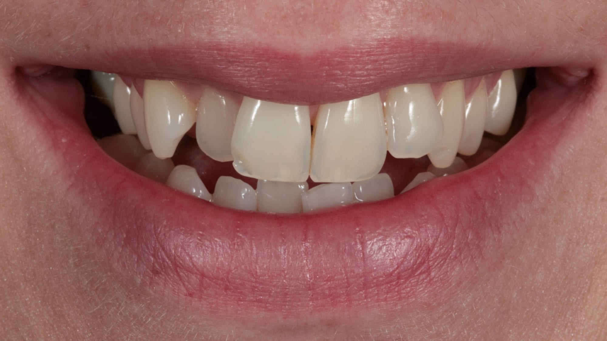 After — Invisalign — straightened, kept natural