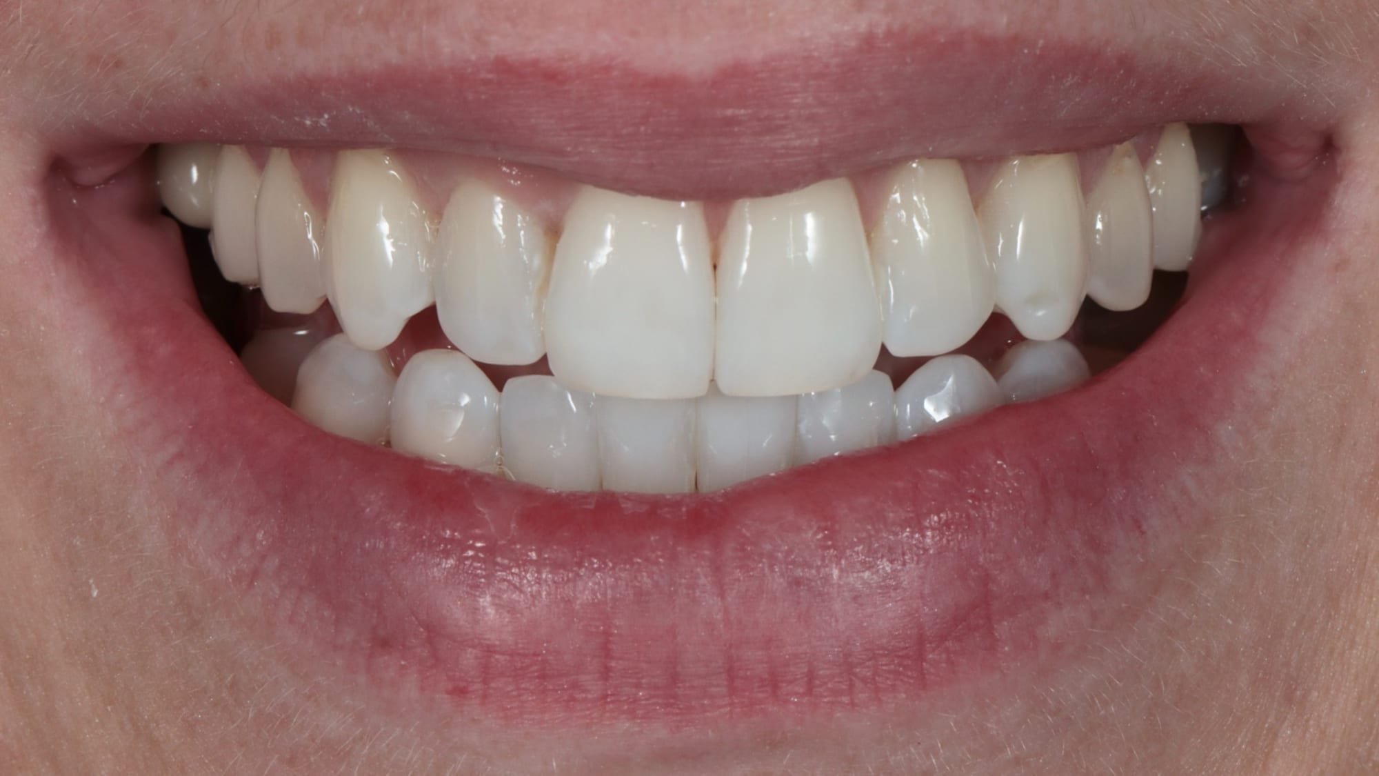 Before — Invisalign — straightened, kept natural