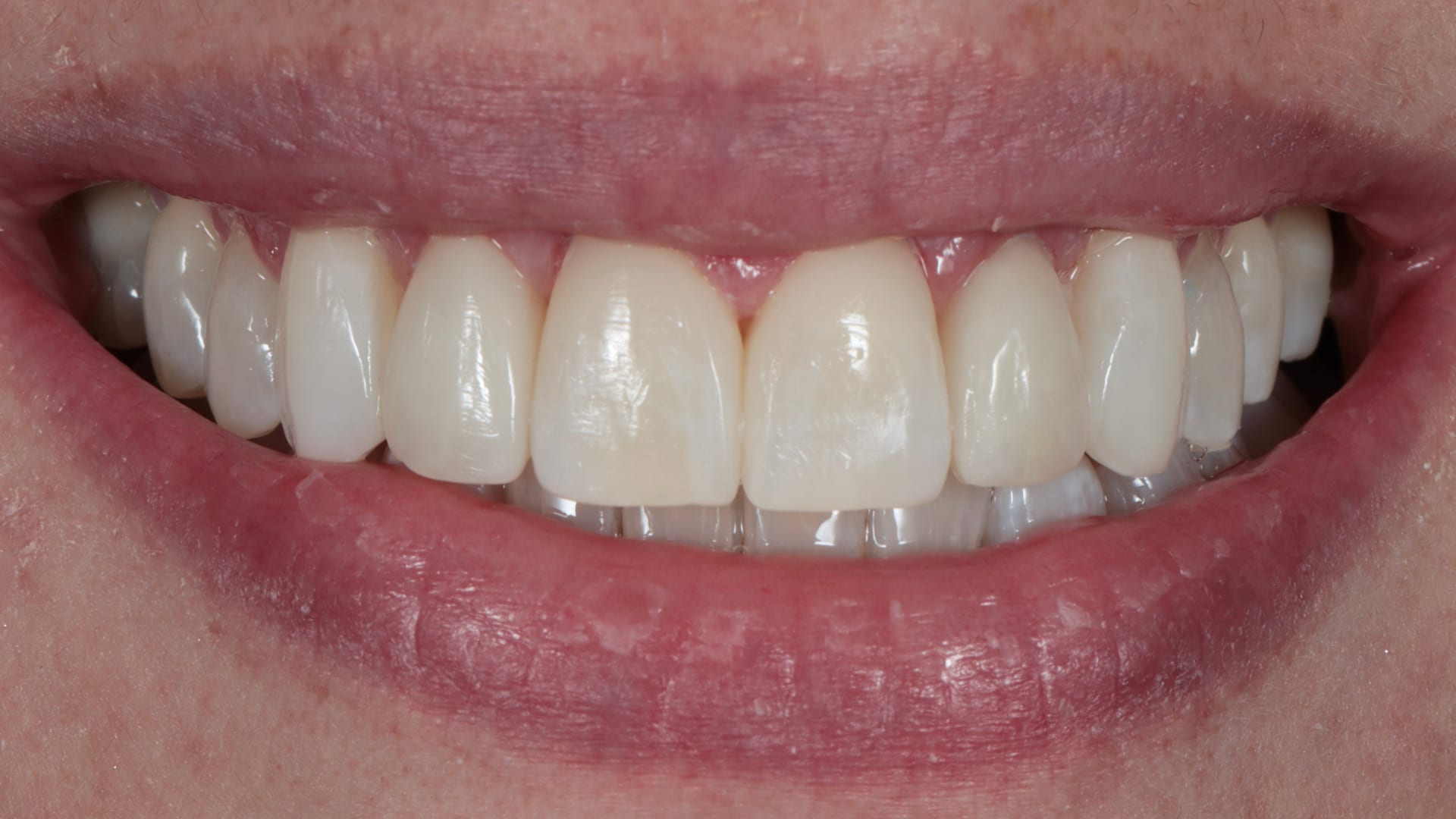 After — Crowding — overlapping teeth realigned