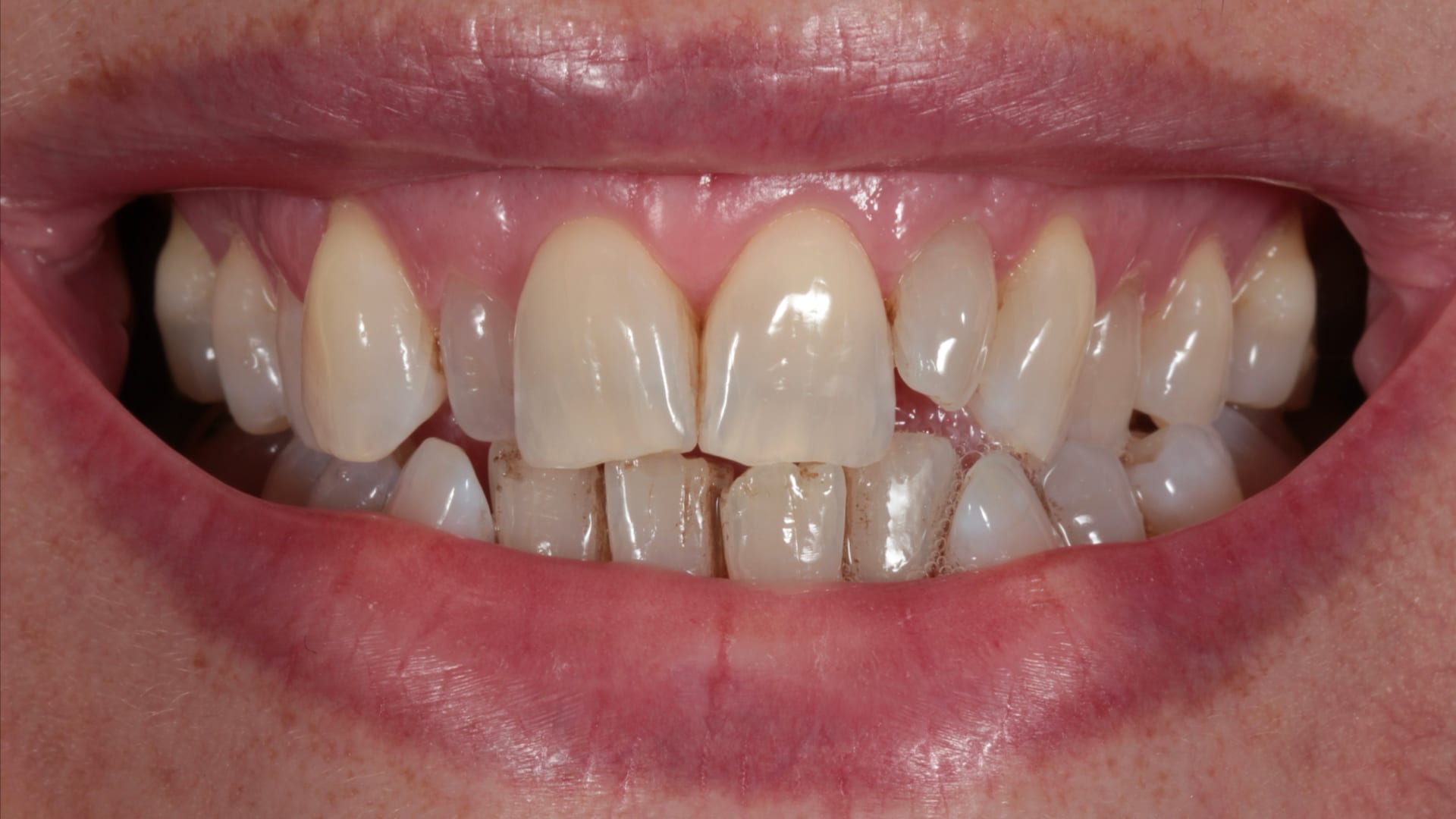 Before — Crowding — overlapping teeth realigned