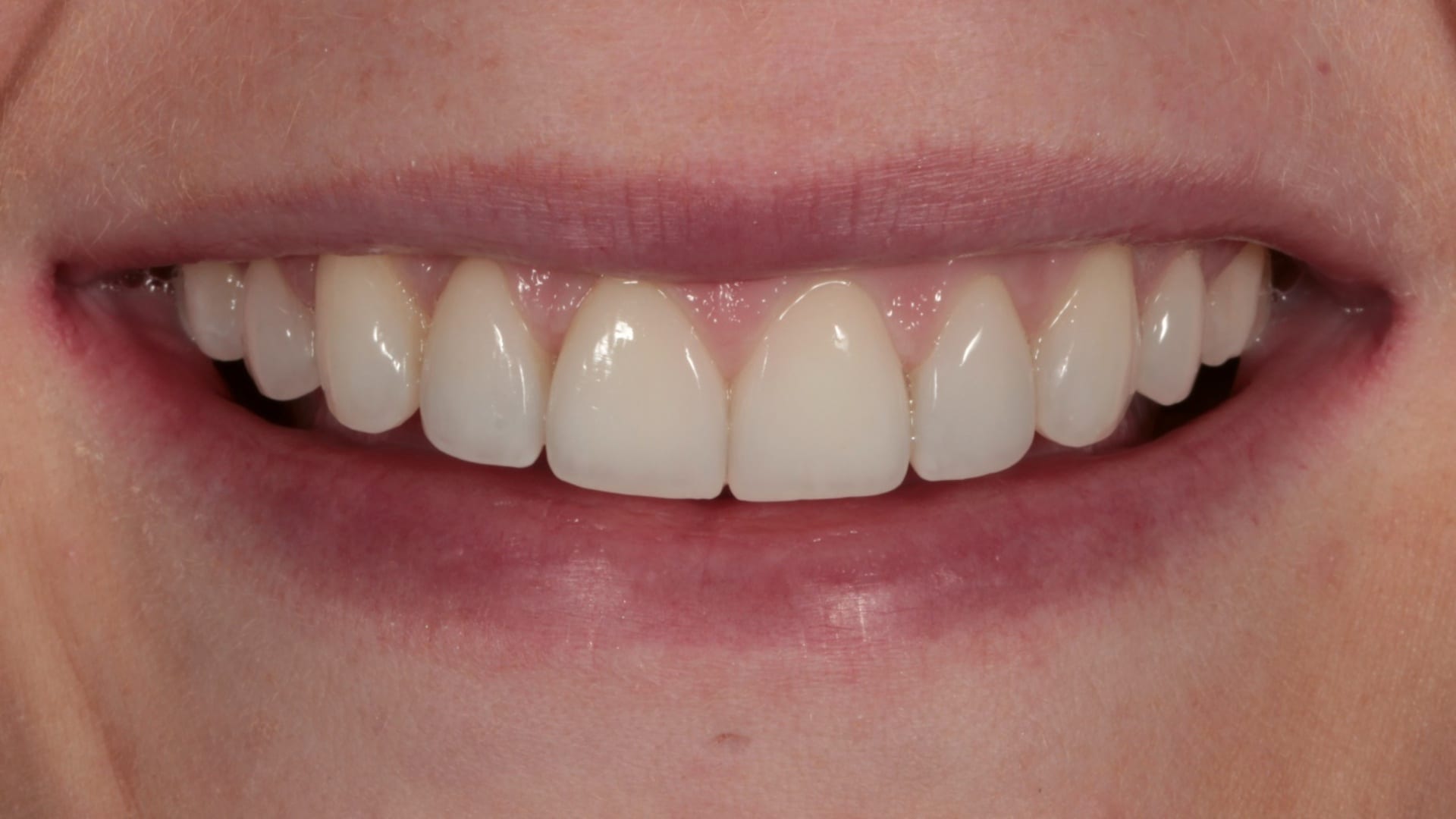 After — Crowding + 8x composite bonding — straightened and polished