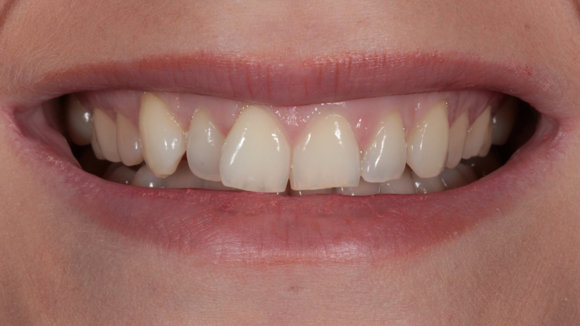 Before — Crowding + 8x composite bonding — straightened and polished