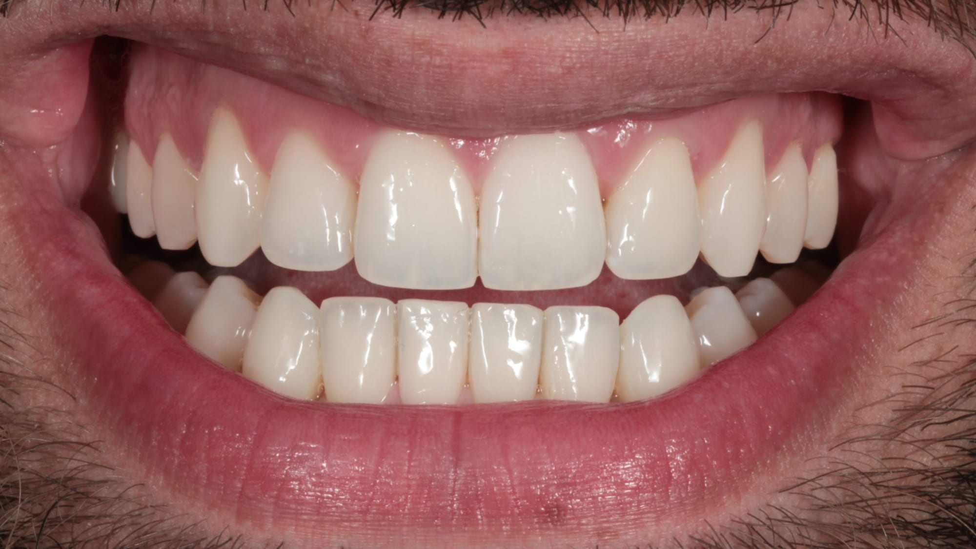 After — Crowding and deep bite correction