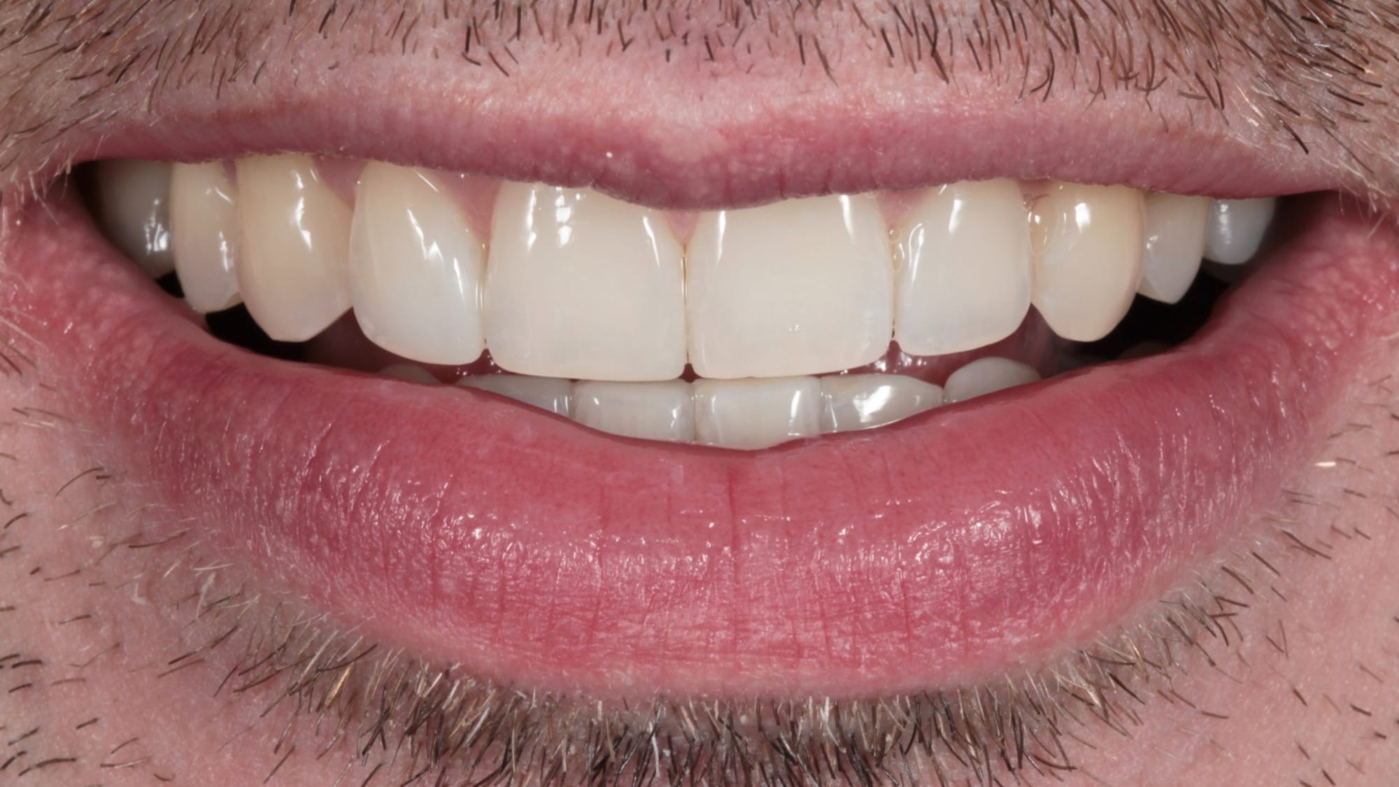 After — Invisalign and 4x composite bonding — crowding, deep bite and tooth wear