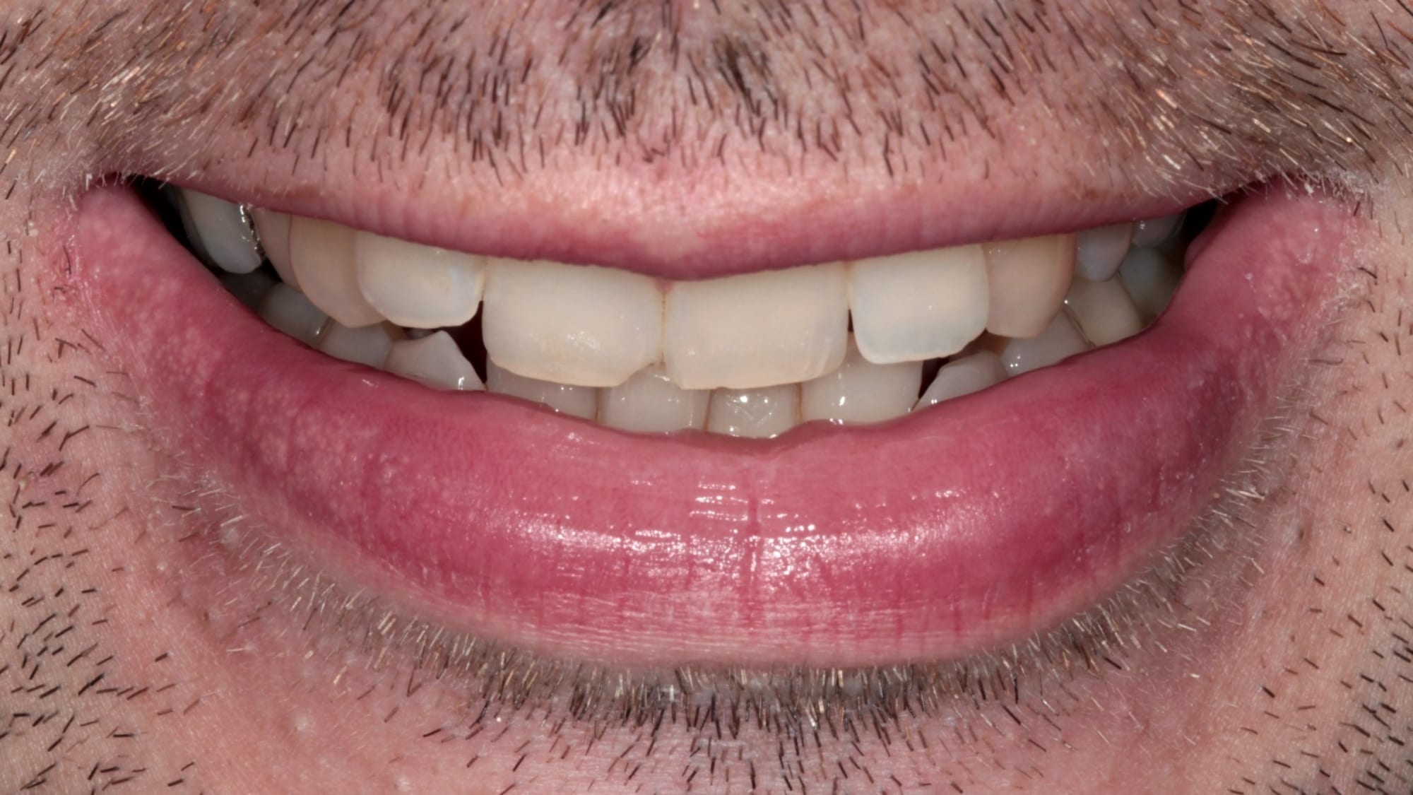 Before — Invisalign and 4x composite bonding — crowding, deep bite and tooth wear