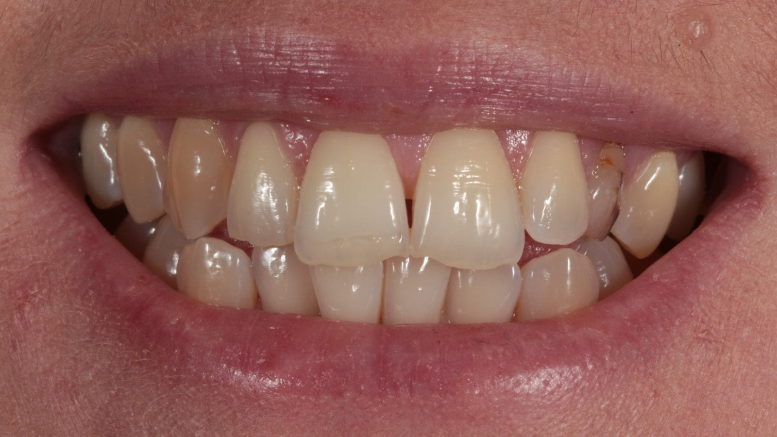 Before — Invisalign, 5x composite bonding & implant — crowding, impacted canine