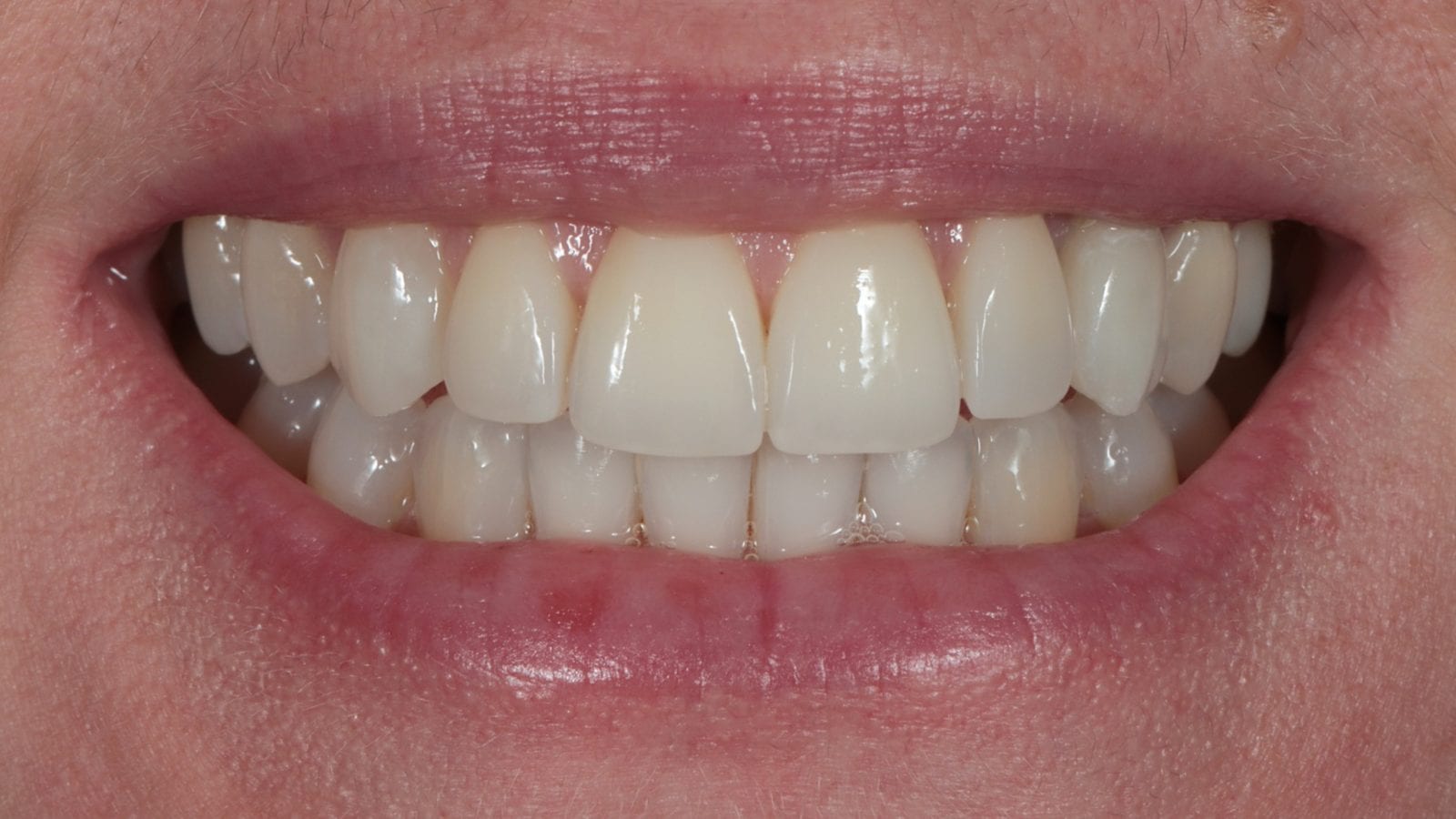 After — Invisalign, 5x composite bonding & implant — crowding, impacted canine