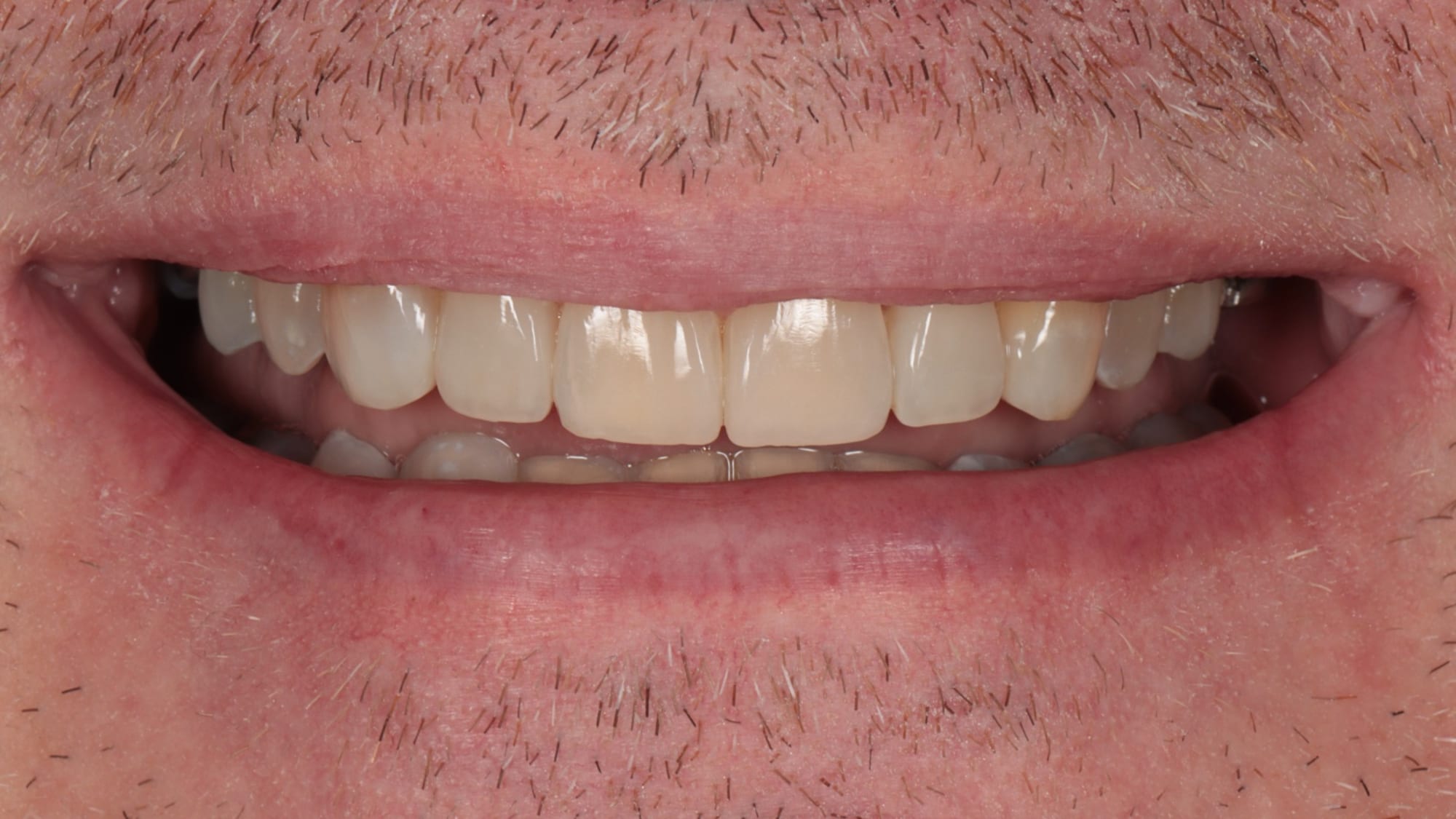 After — Invisalign and 6x natural composite bonding/veneers — crowding