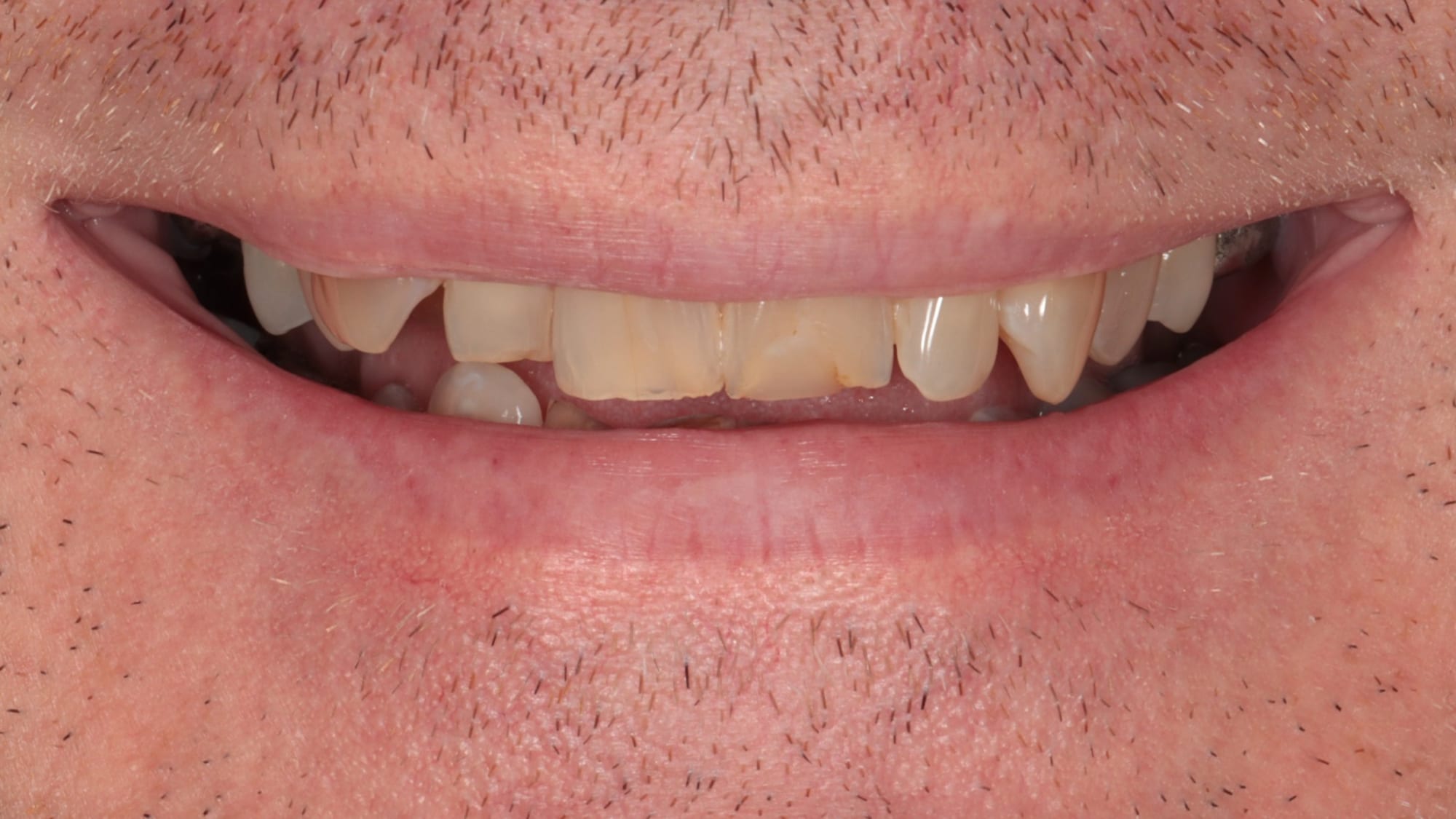 Before — Invisalign and 6x natural composite bonding/veneers — crowding