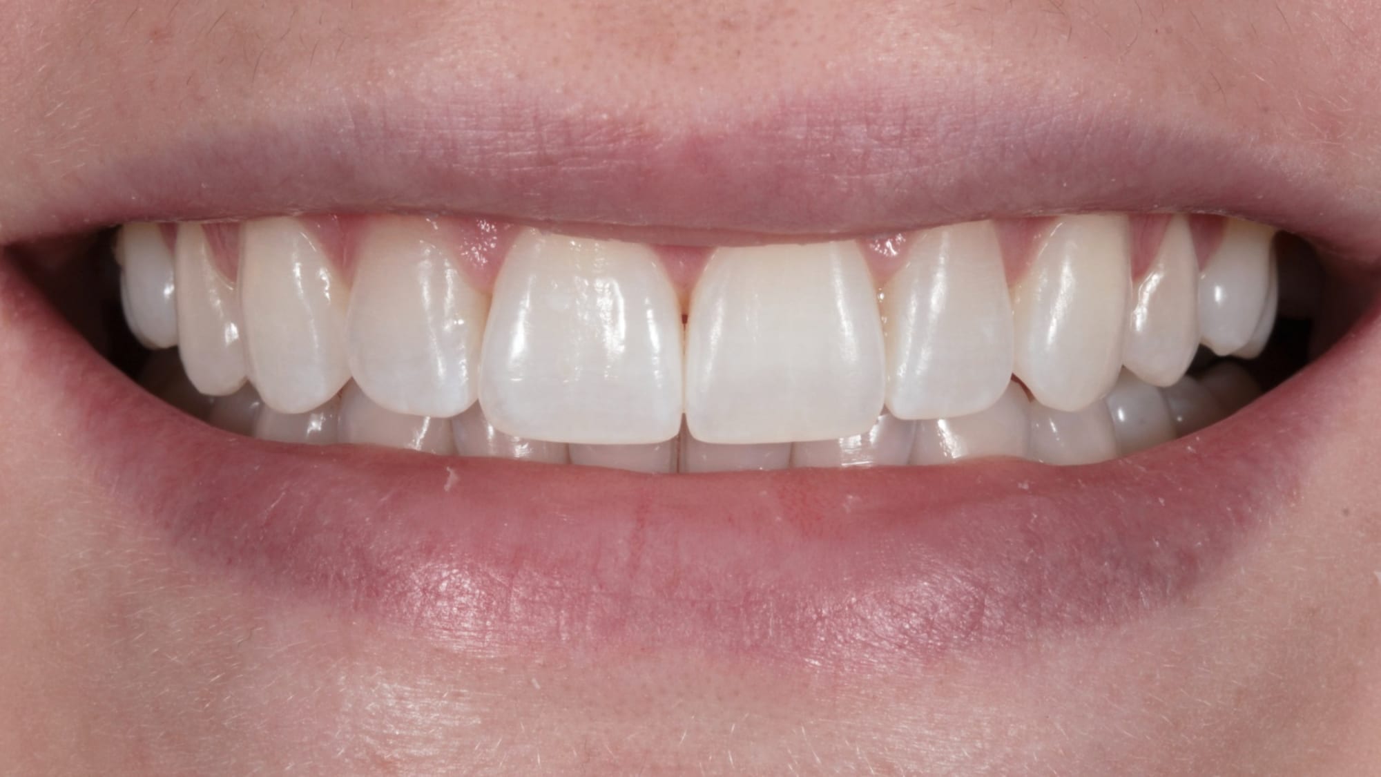 After — Crowding and prominent canines