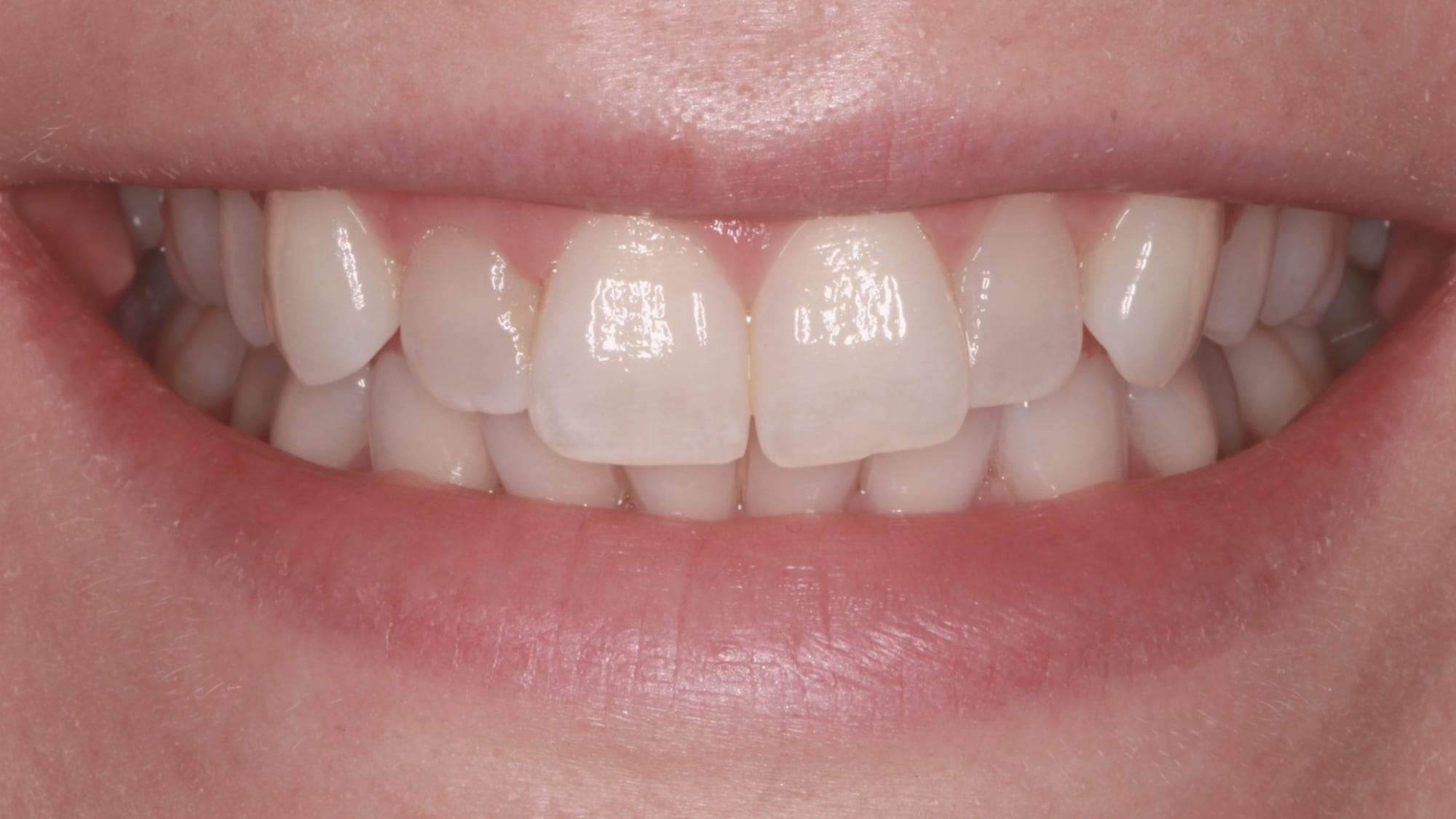 Before — Crowding and prominent canines