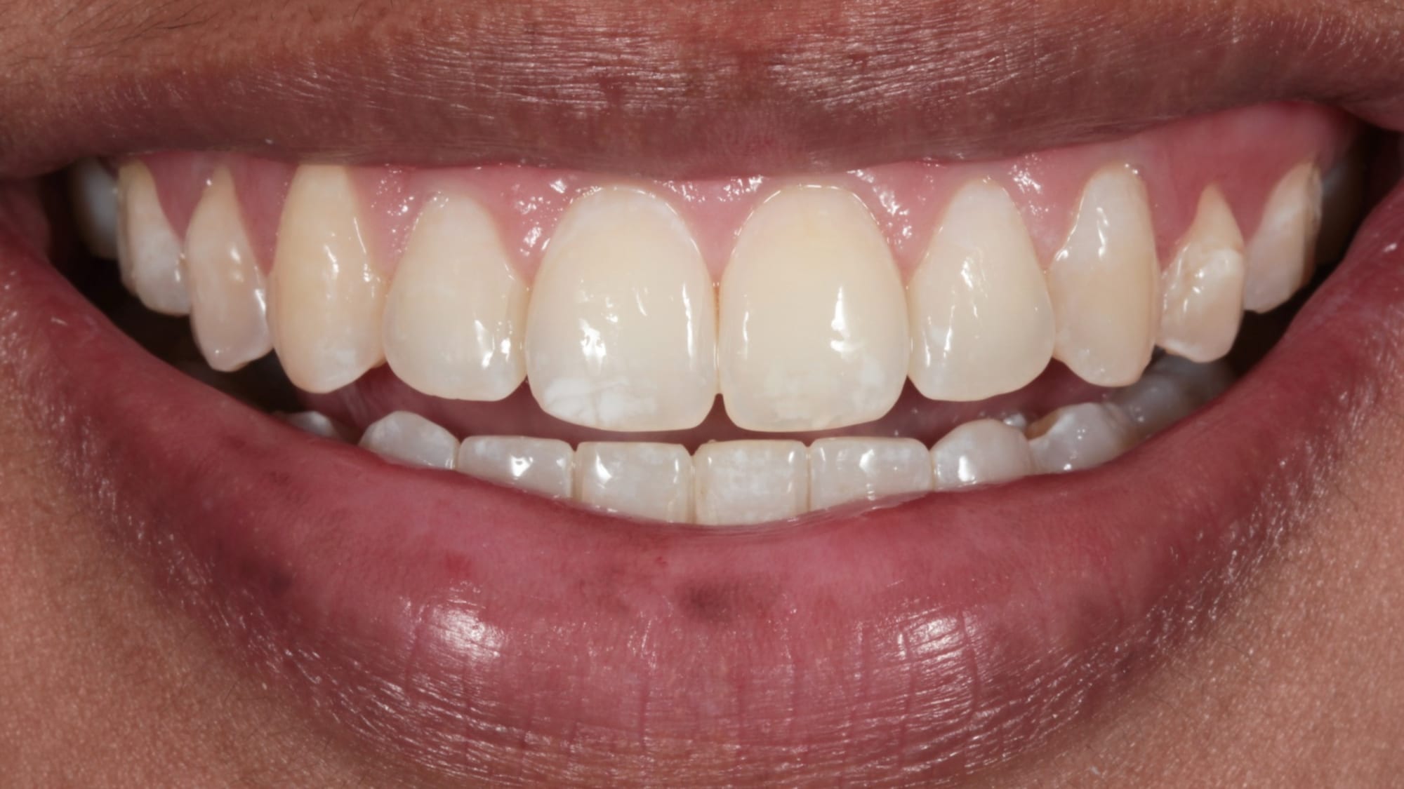 After — Crowding, rotations and uneven smile