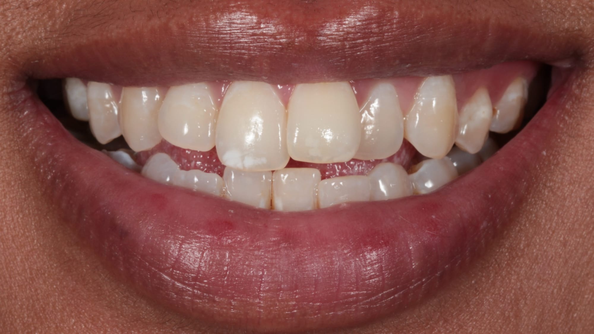Before — Crowding, rotations and uneven smile