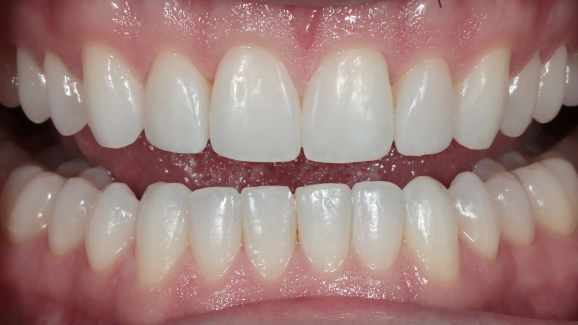 After — Invisalign and 6x natural composite bonding — crowding and tooth shape improvement