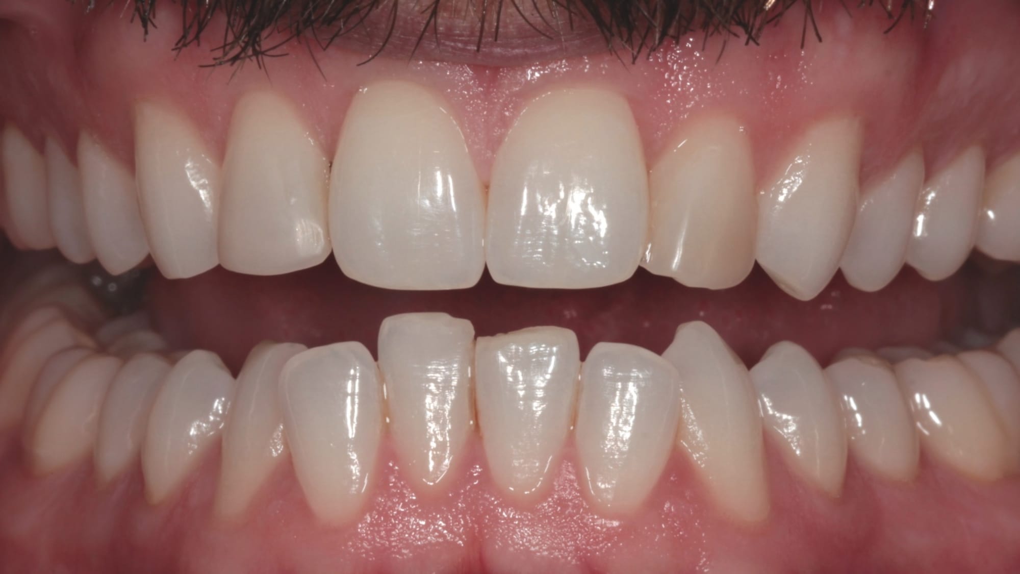 Before — Invisalign and 6x natural composite bonding — crowding and tooth shape improvement