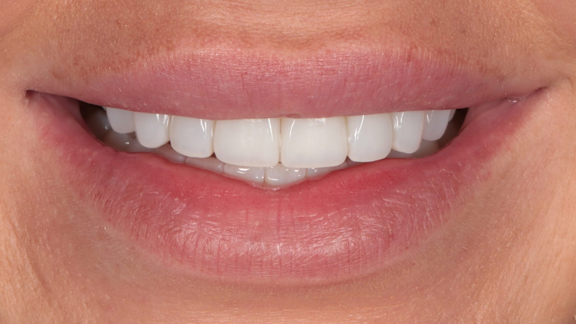 After — Invisalign and 8x Hollywood composite veneers — crowding and lack of volume