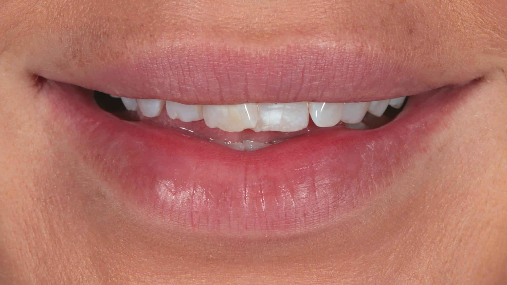 Before — Invisalign and 8x Hollywood composite veneers — crowding and lack of volume