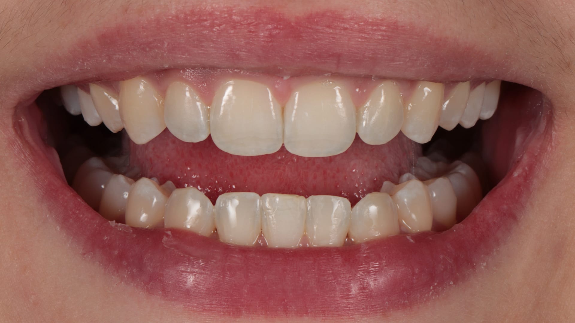 After — Deep bite corrected — comfort and aesthetics