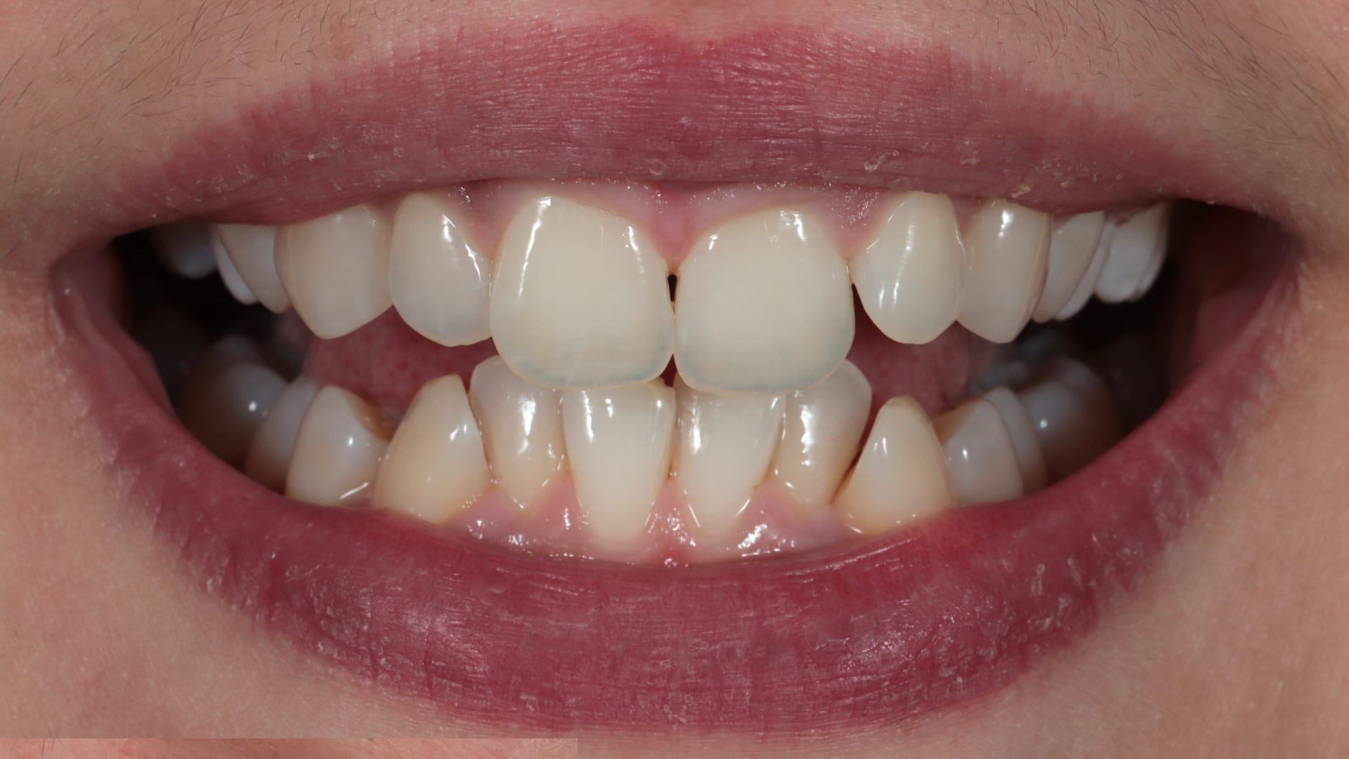 Before — Deep bite corrected — comfort and aesthetics
