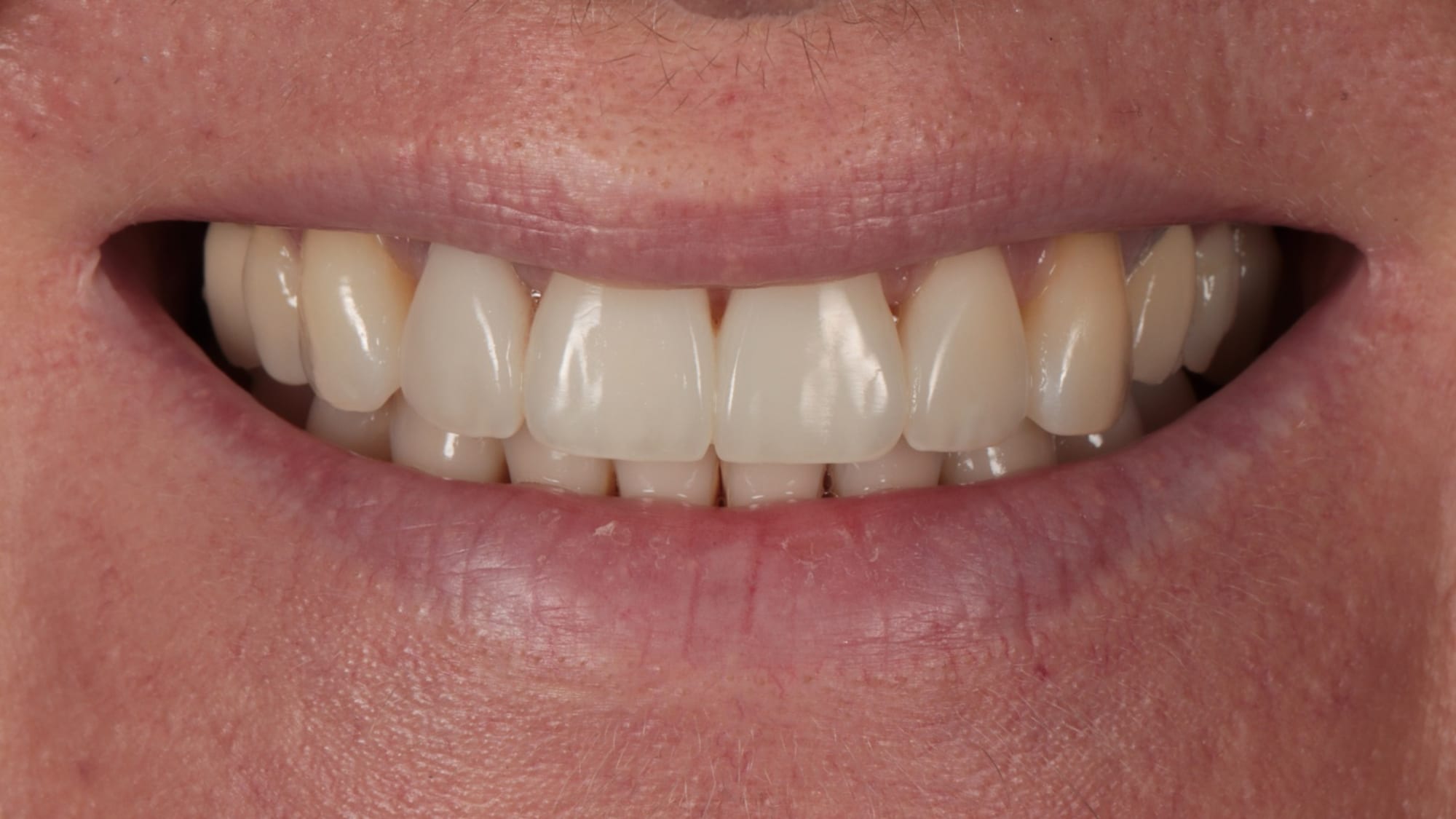 After — Invisalign and 4x natural composite bonding — flared, discoloured teeth and tooth wear