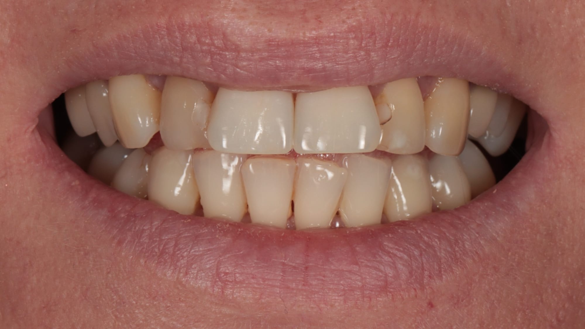 Before — Invisalign and 4x natural composite bonding — flared, discoloured teeth and tooth wear