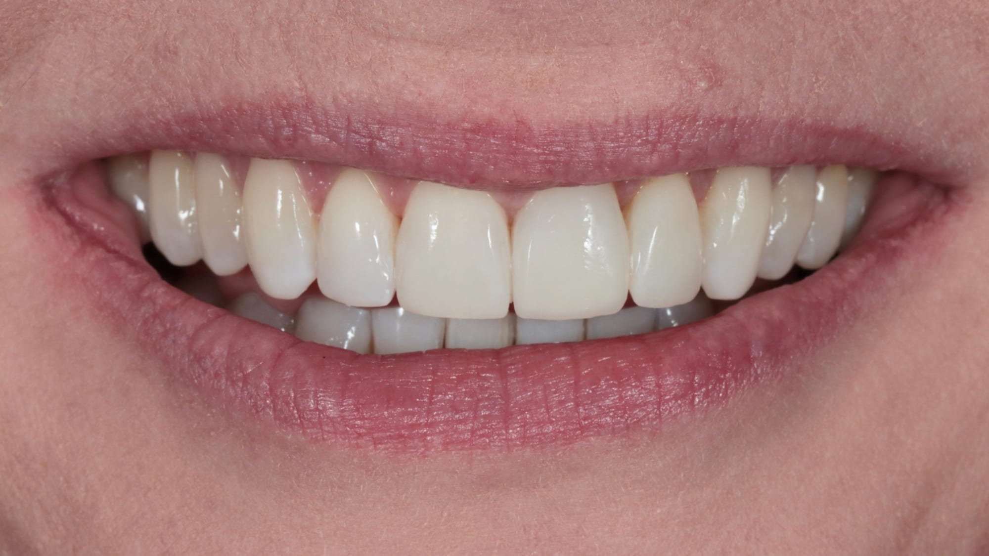 After — Invisalign and 4x natural composite bonding/veneers — flared teeth, overjet