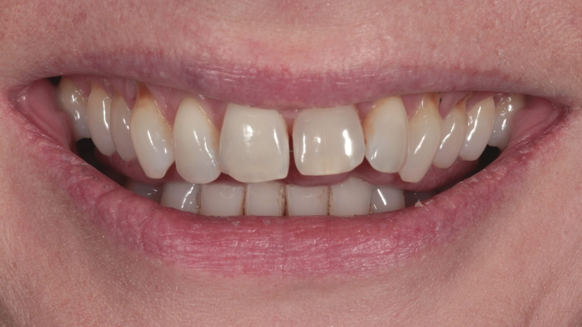 Before — Invisalign and 4x natural composite bonding/veneers — flared teeth, overjet