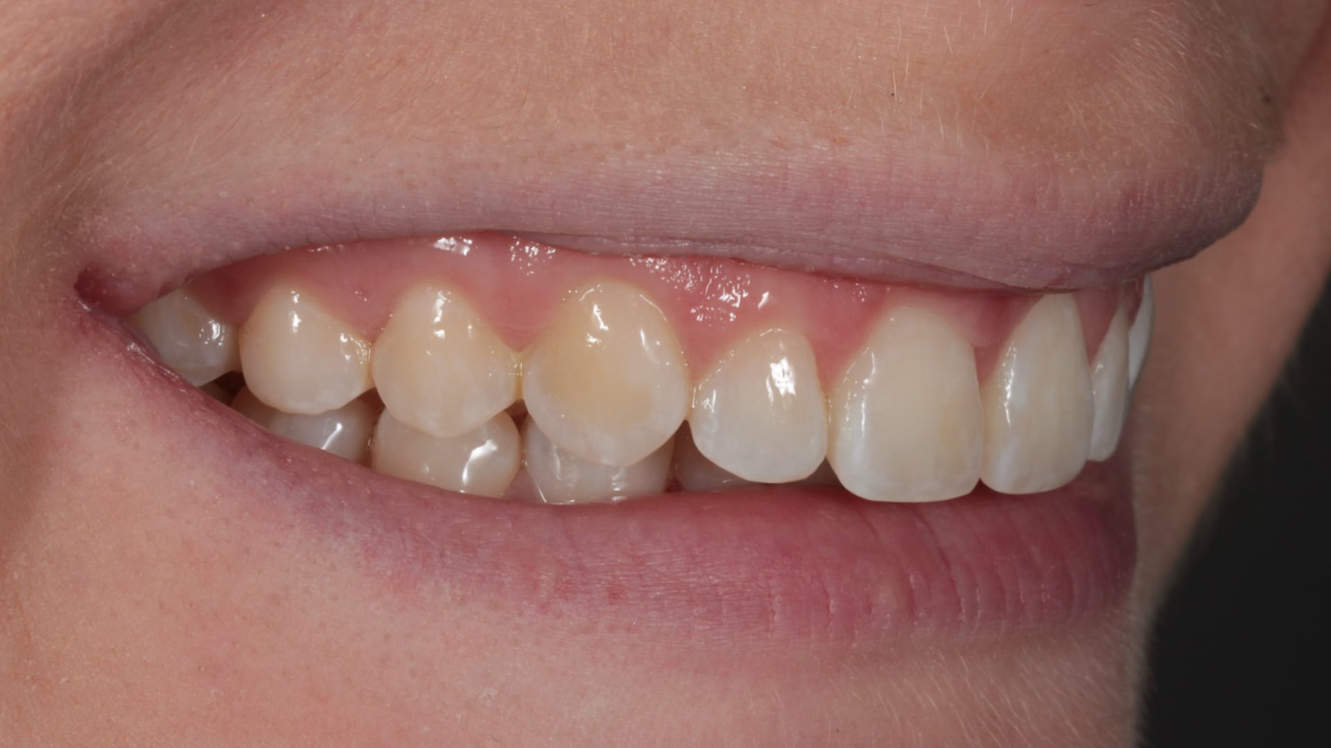 After — Gaps closed — even, balanced smile line