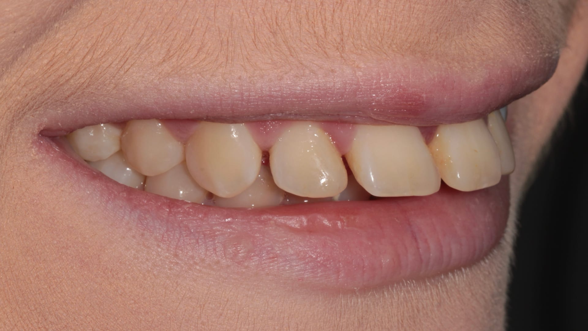 Before — Gaps closed — even, balanced smile line