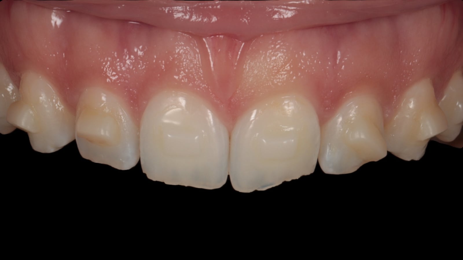 Invisalign attachments — small tooth-coloured composite bumps bonded to the teeth so the aligners can grip and move them precisely