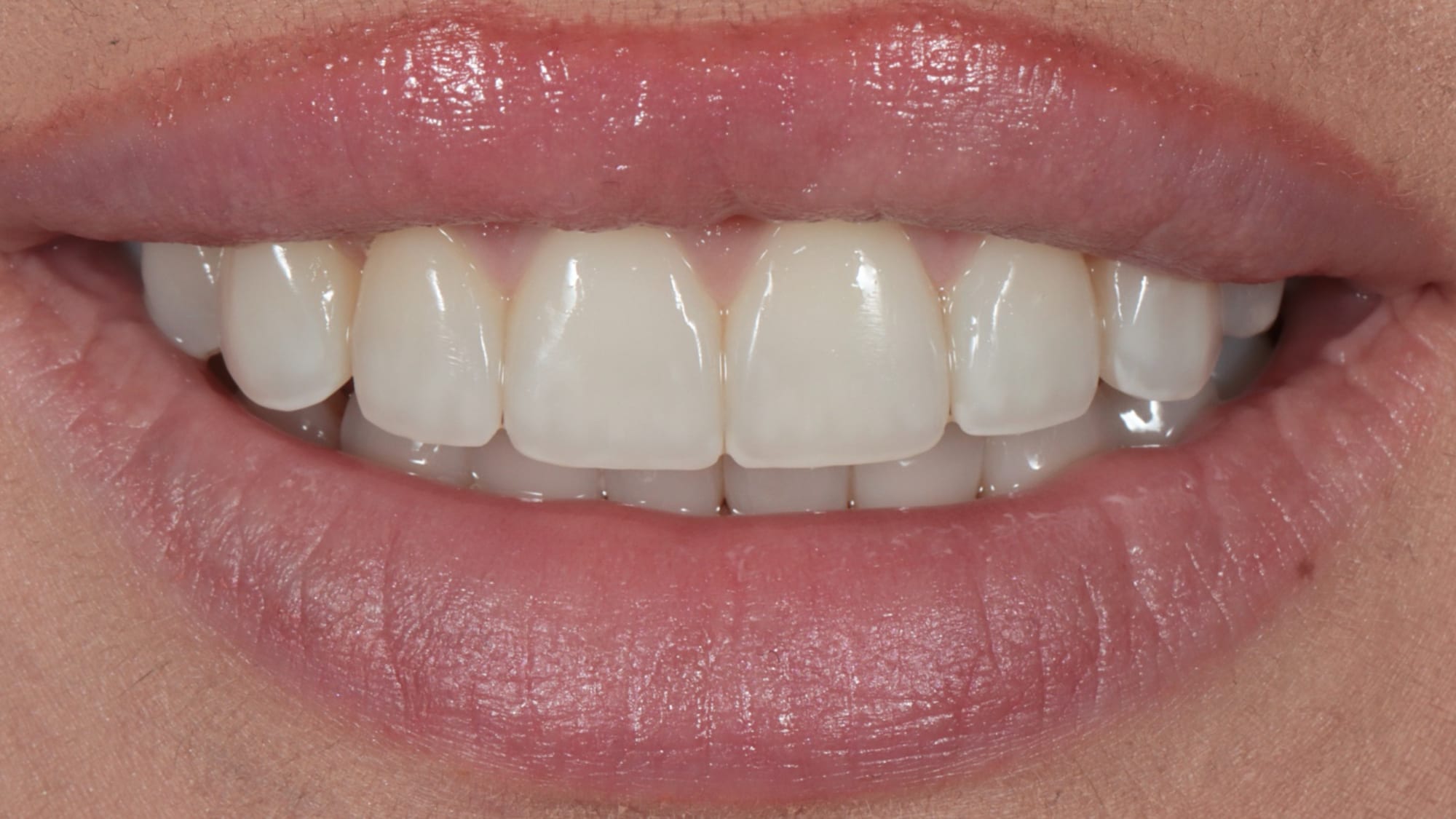 After — Invisalign and 6x natural composite veneers