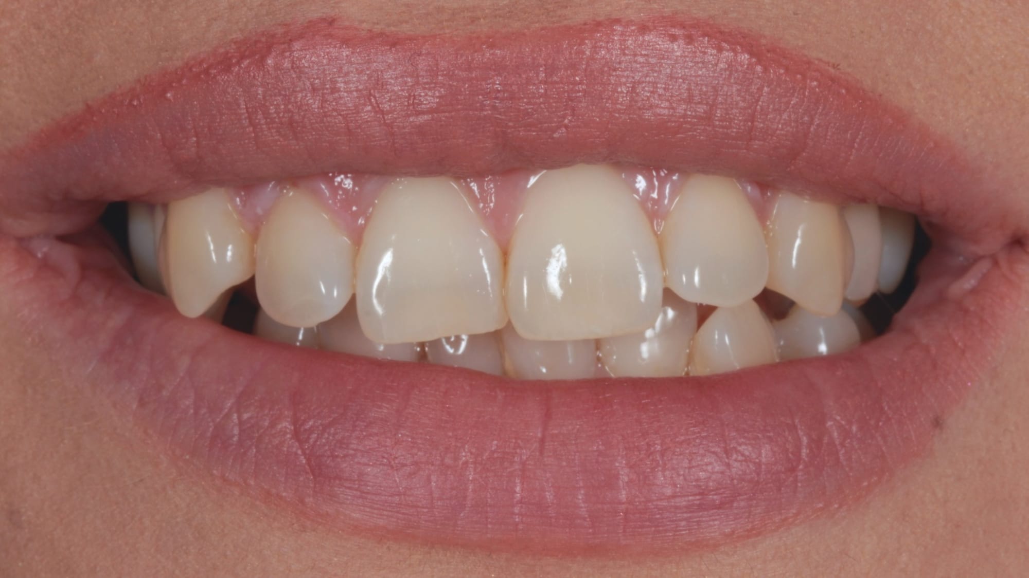 Before — Invisalign and 6x natural composite veneers