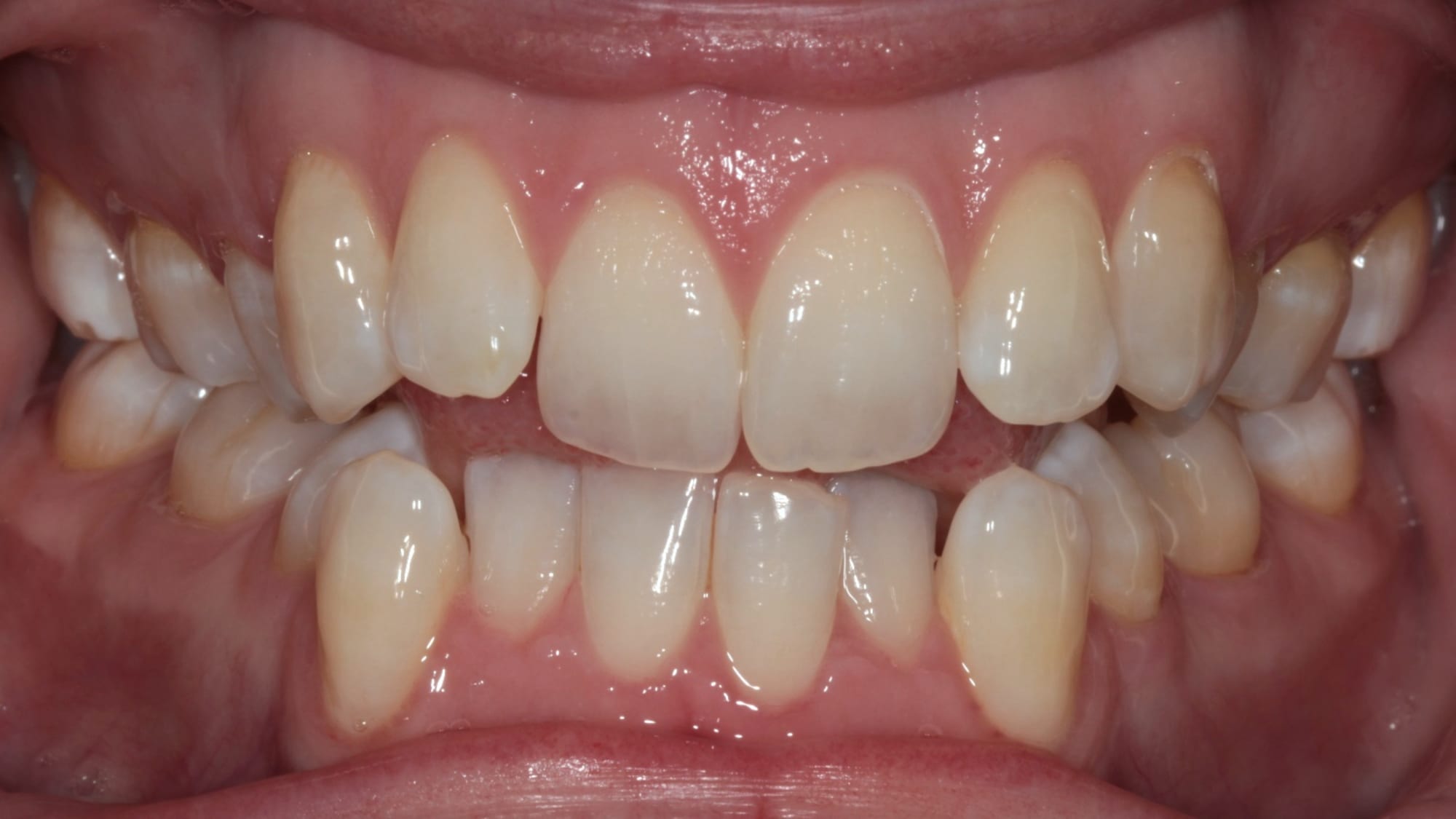 After — Narrow arch, bite management and crowding