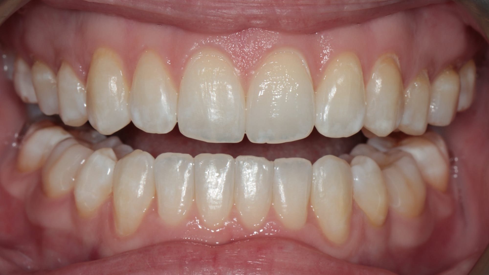 Before — Narrow arch, bite management and crowding