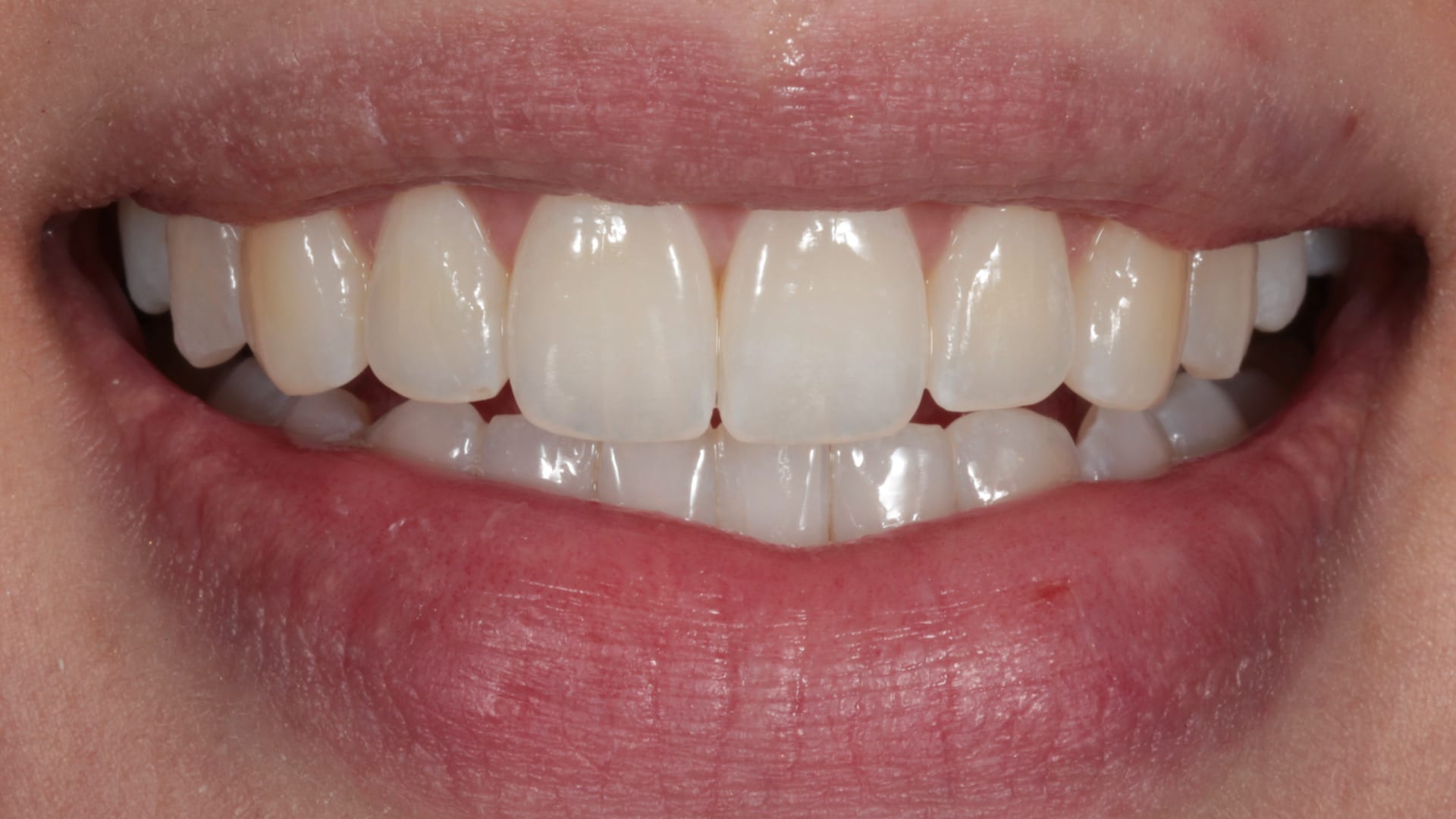 After — Narrow smile — broadened for a fuller arch