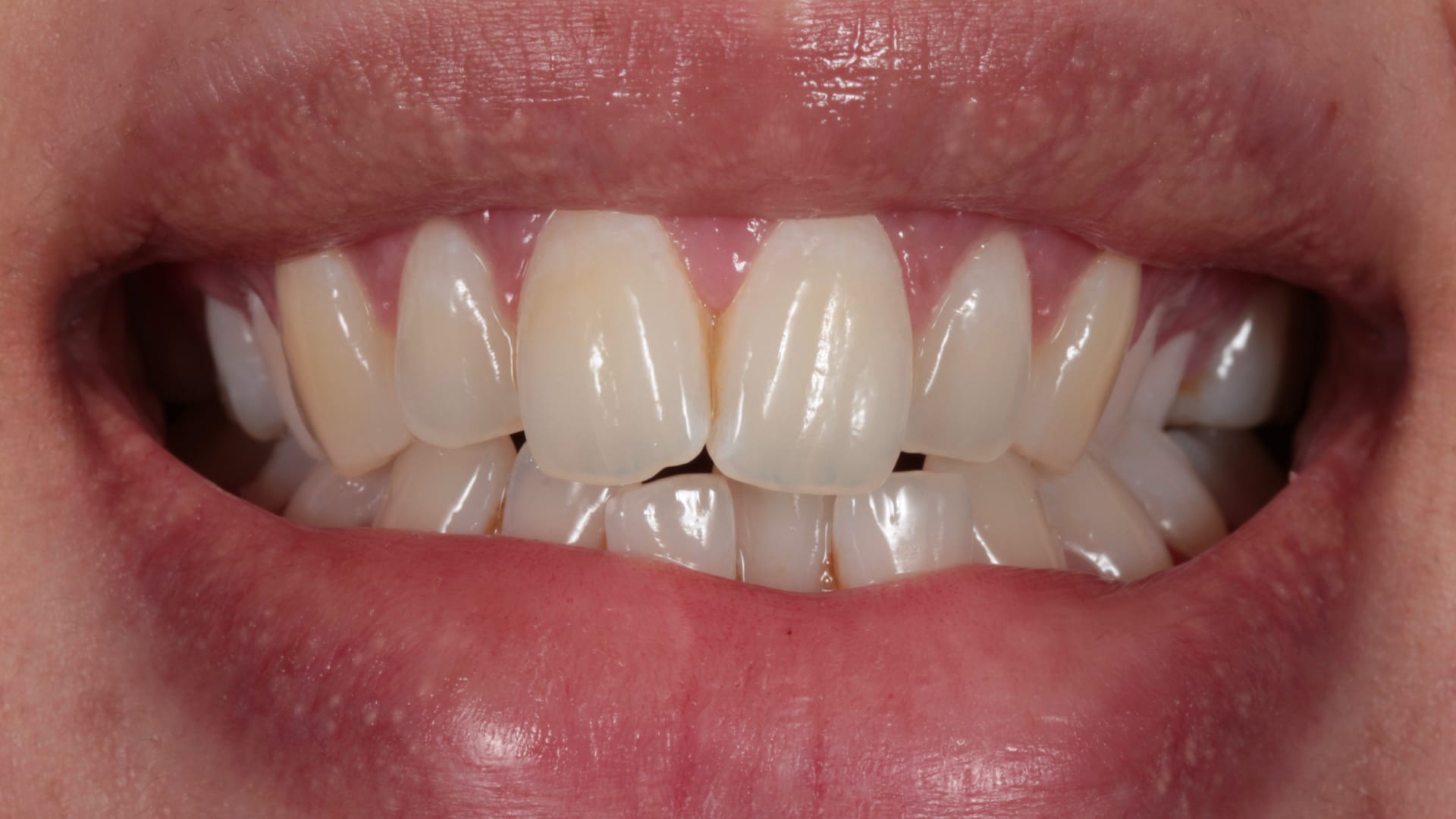 Before — Narrow smile — broadened for a fuller arch