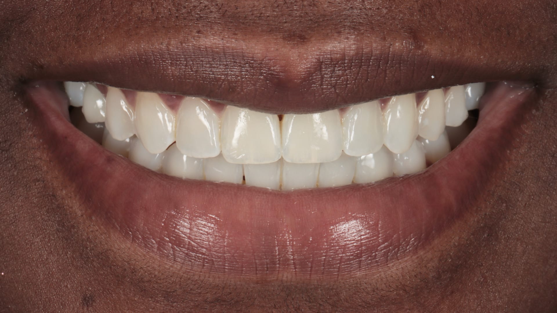 After — Open bite — front teeth meeting properly