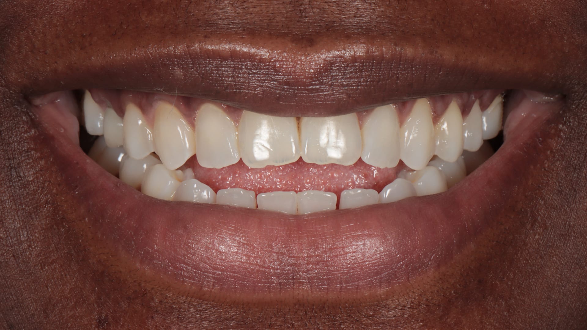 Before — Open bite — front teeth meeting properly