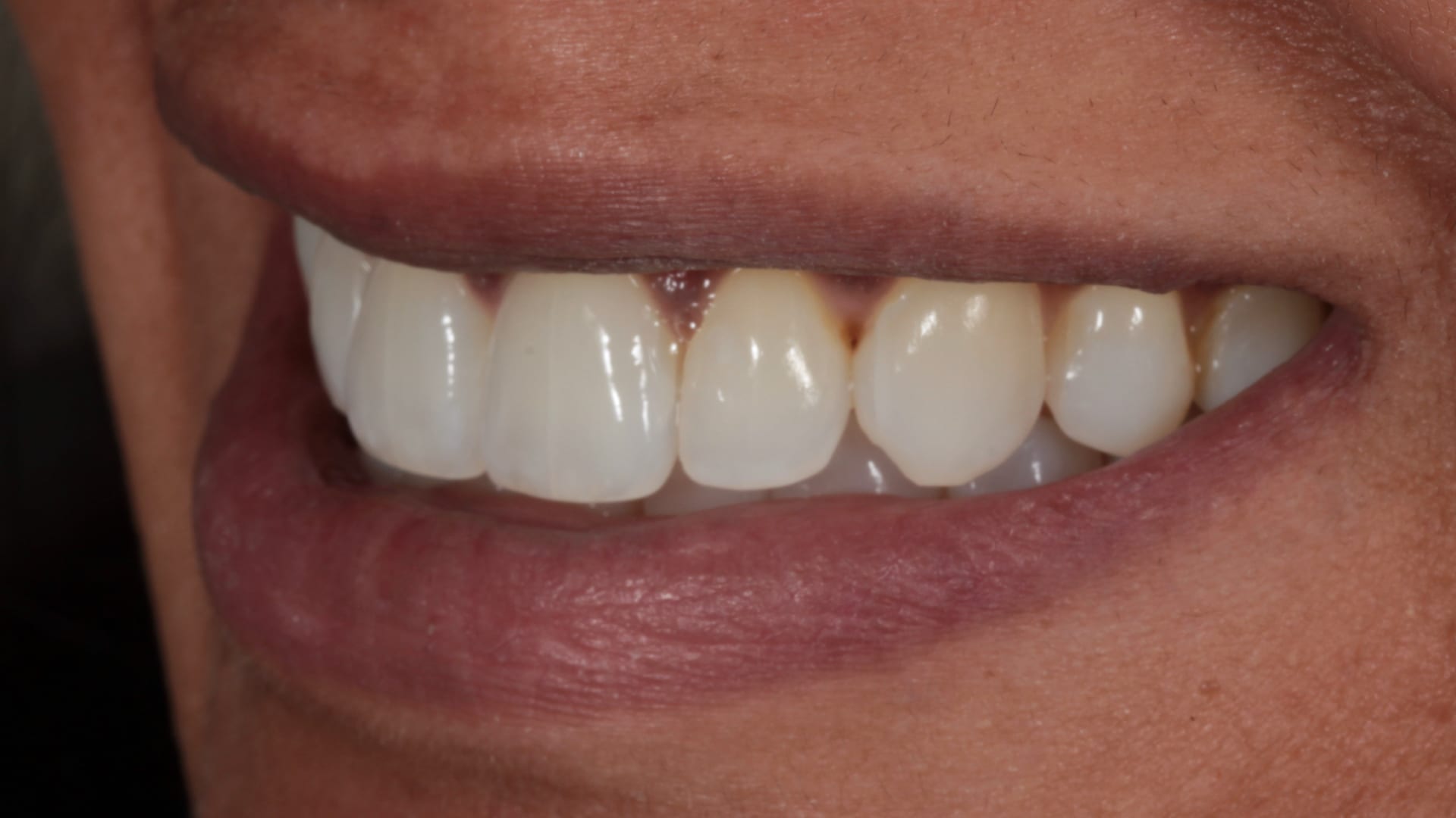 After — Overjet — front teeth pulled back into balance