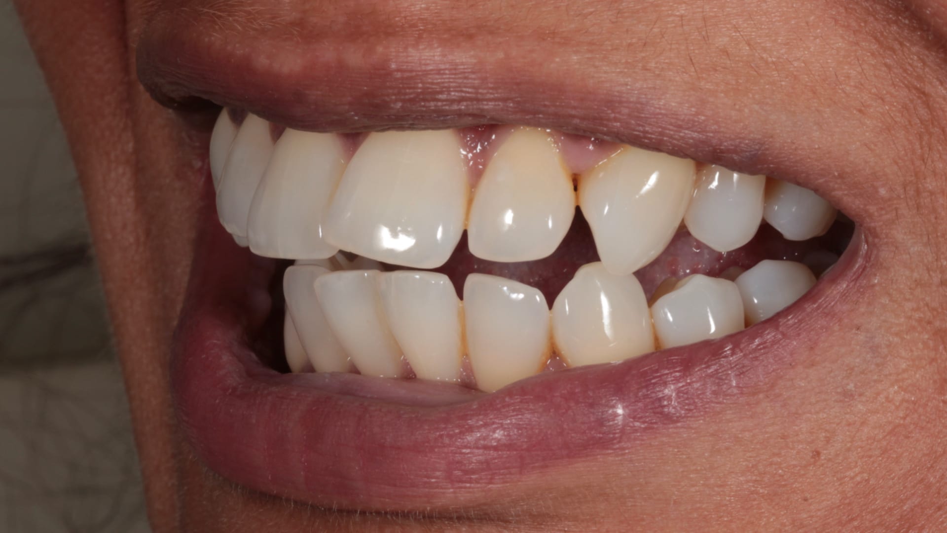 Before — Overjet — front teeth pulled back into balance