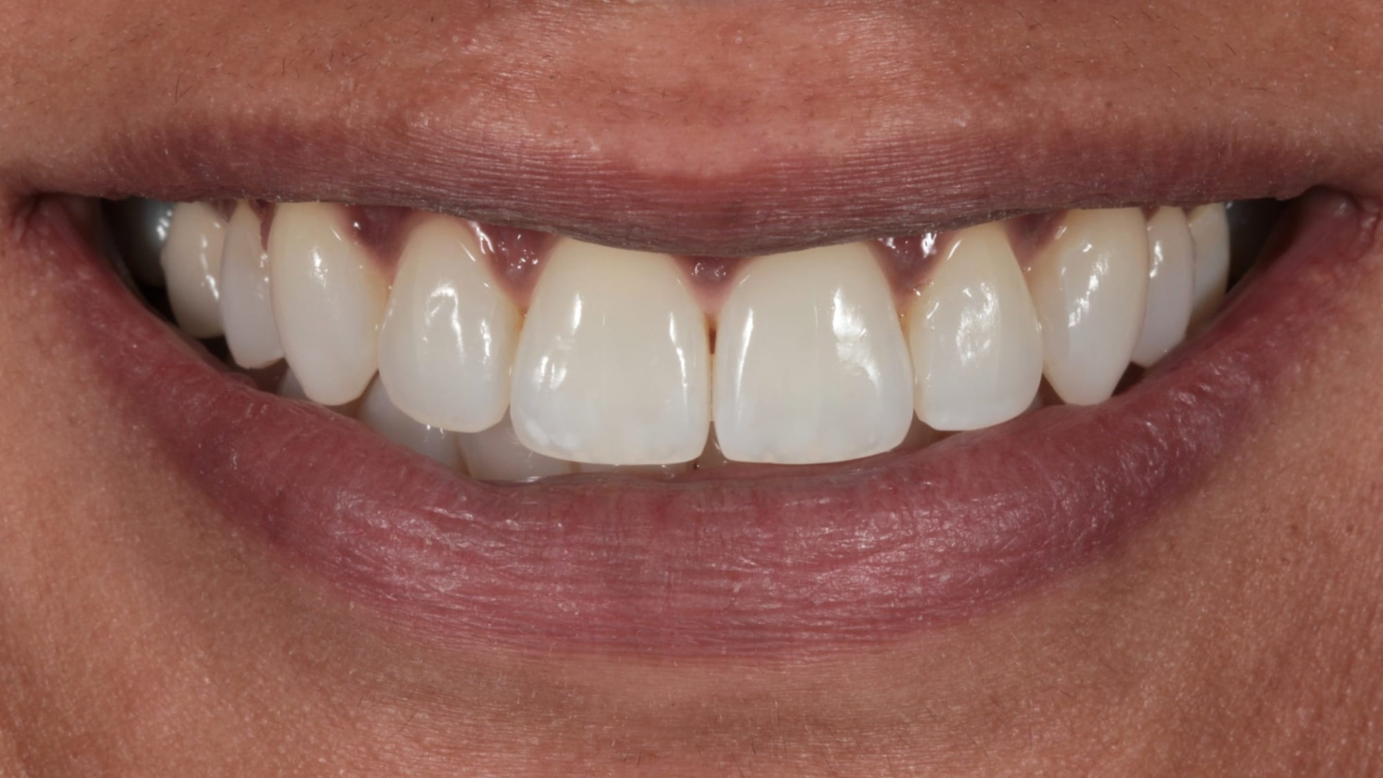 After — Overjet, overbite, flared teeth and crowding