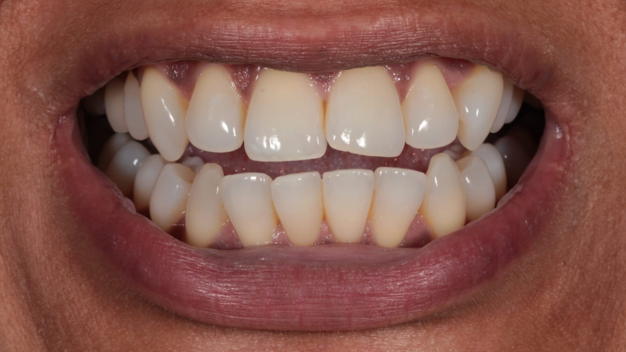 Before — Overjet, overbite, flared teeth and crowding