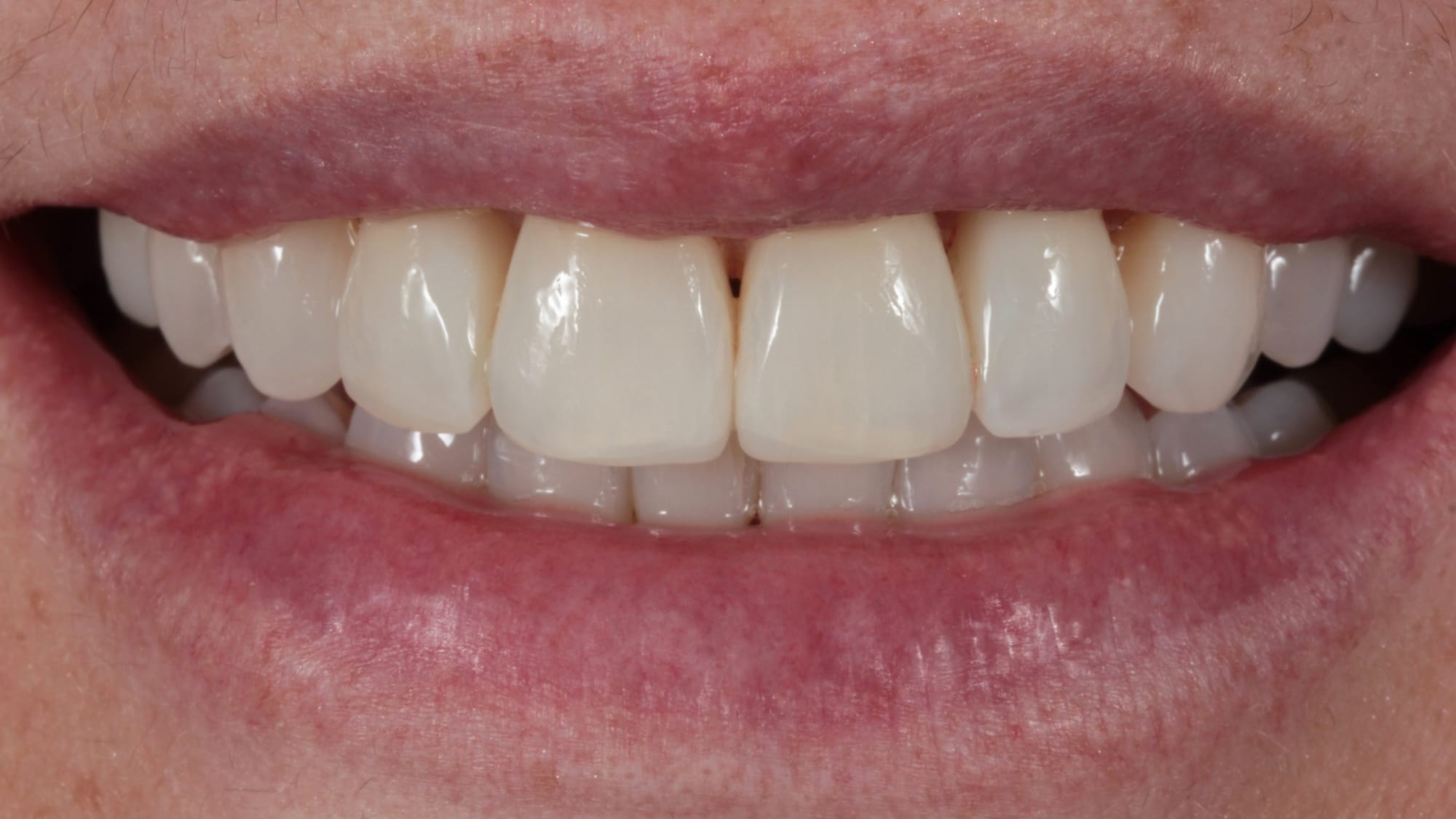 After — Rotations — twisted teeth refined back into line